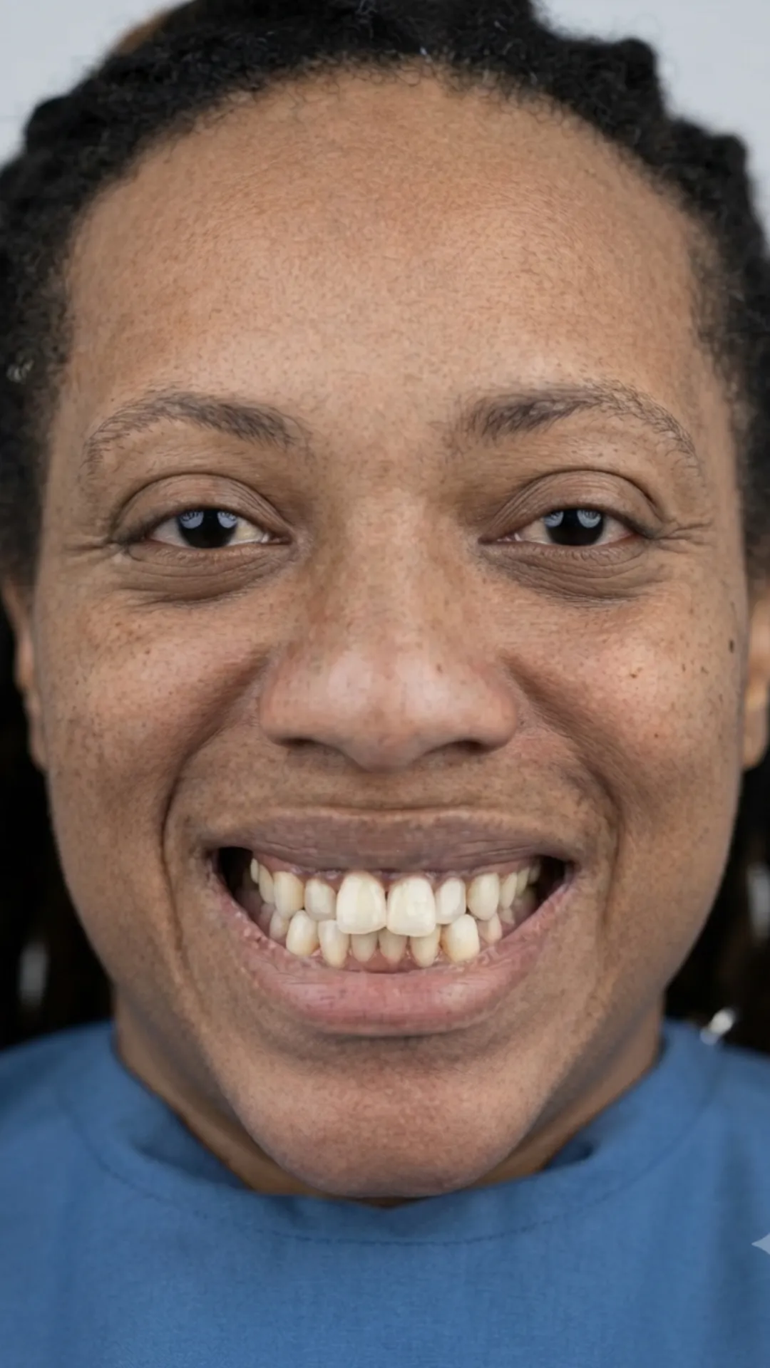 Before teeth straightening at Dental & Wellness London, Islington
