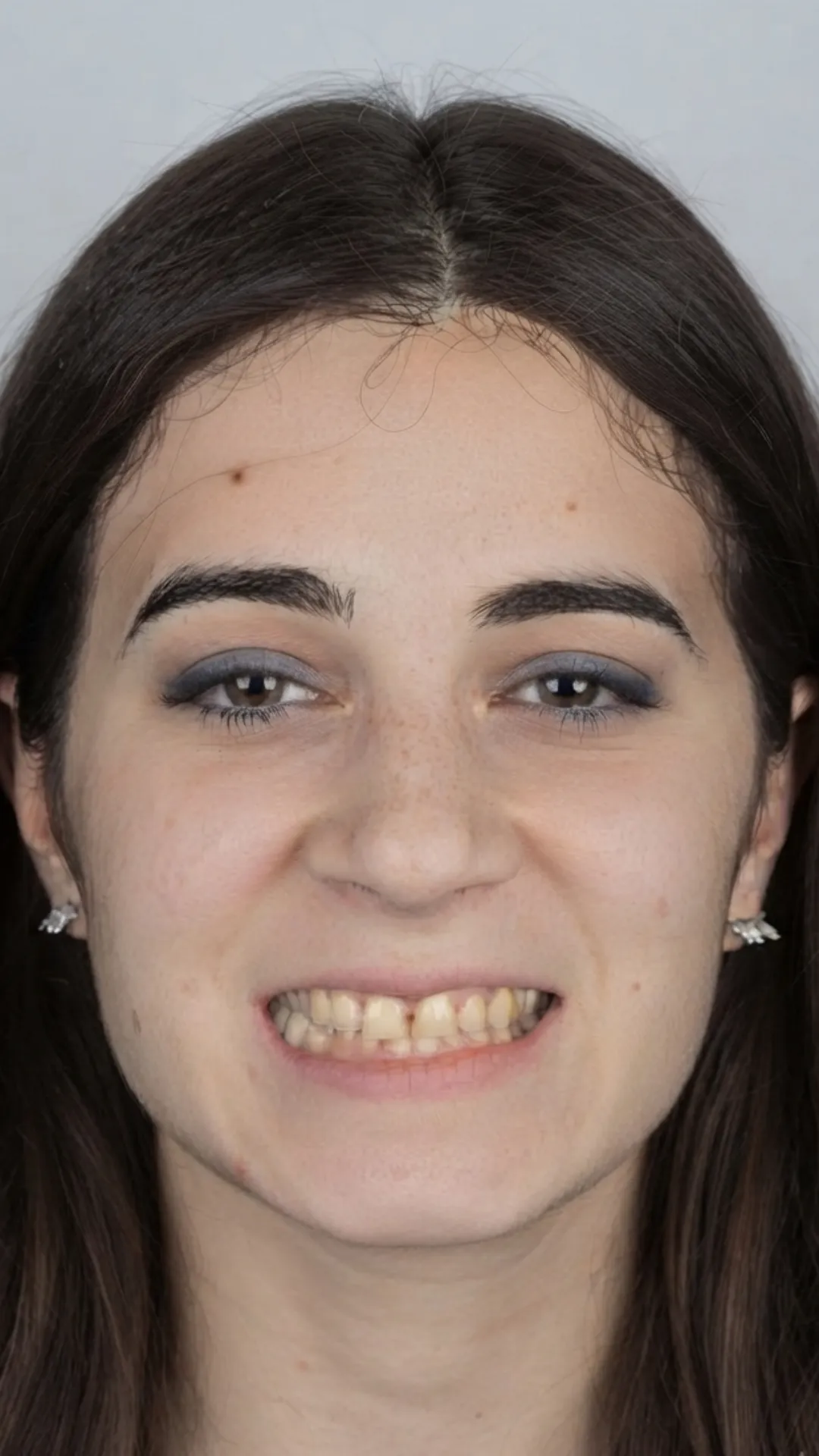 Before teeth straightening at Dental & Wellness London, Islington