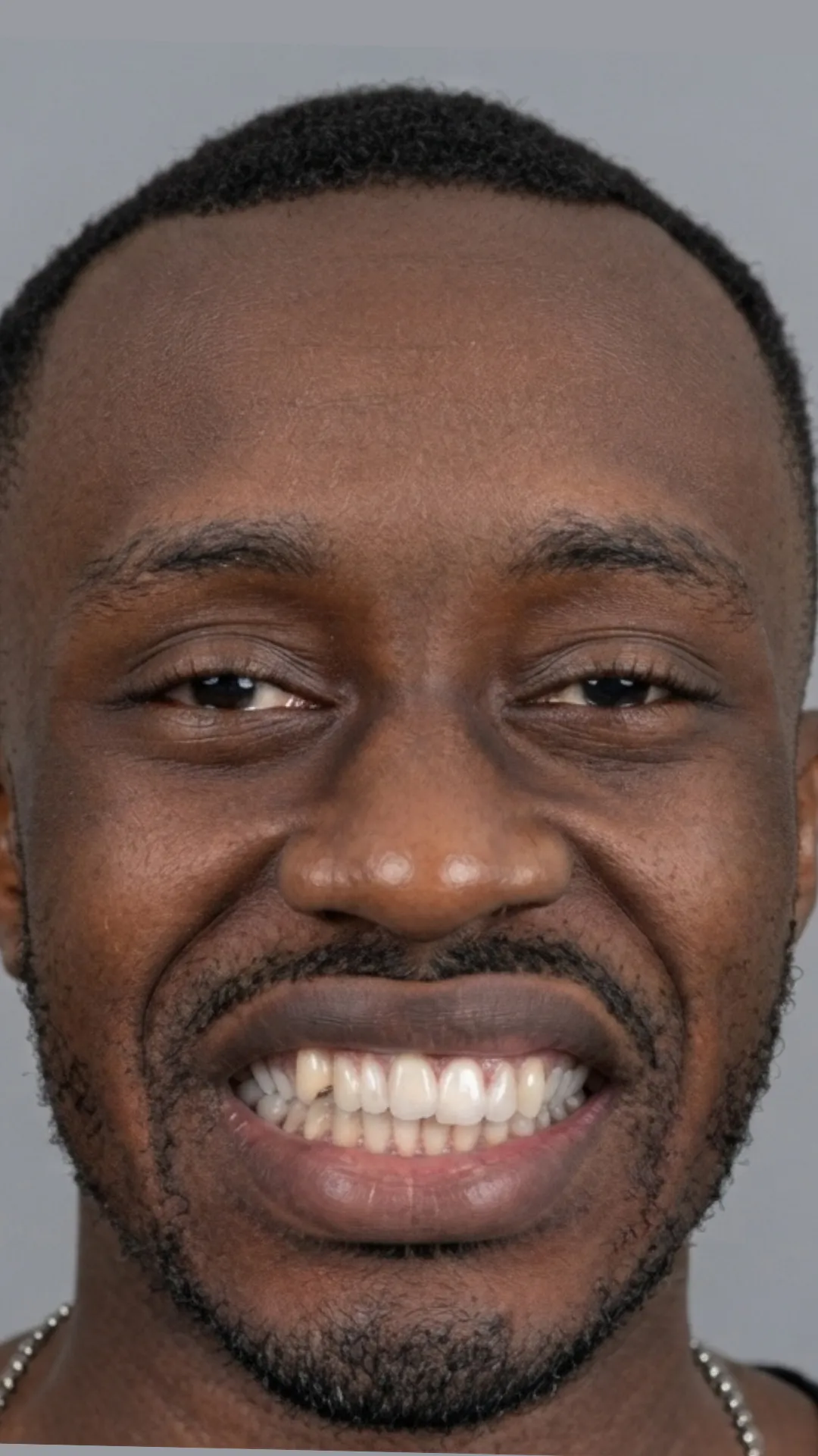Before teeth straightening at Dental & Wellness London, Islington
