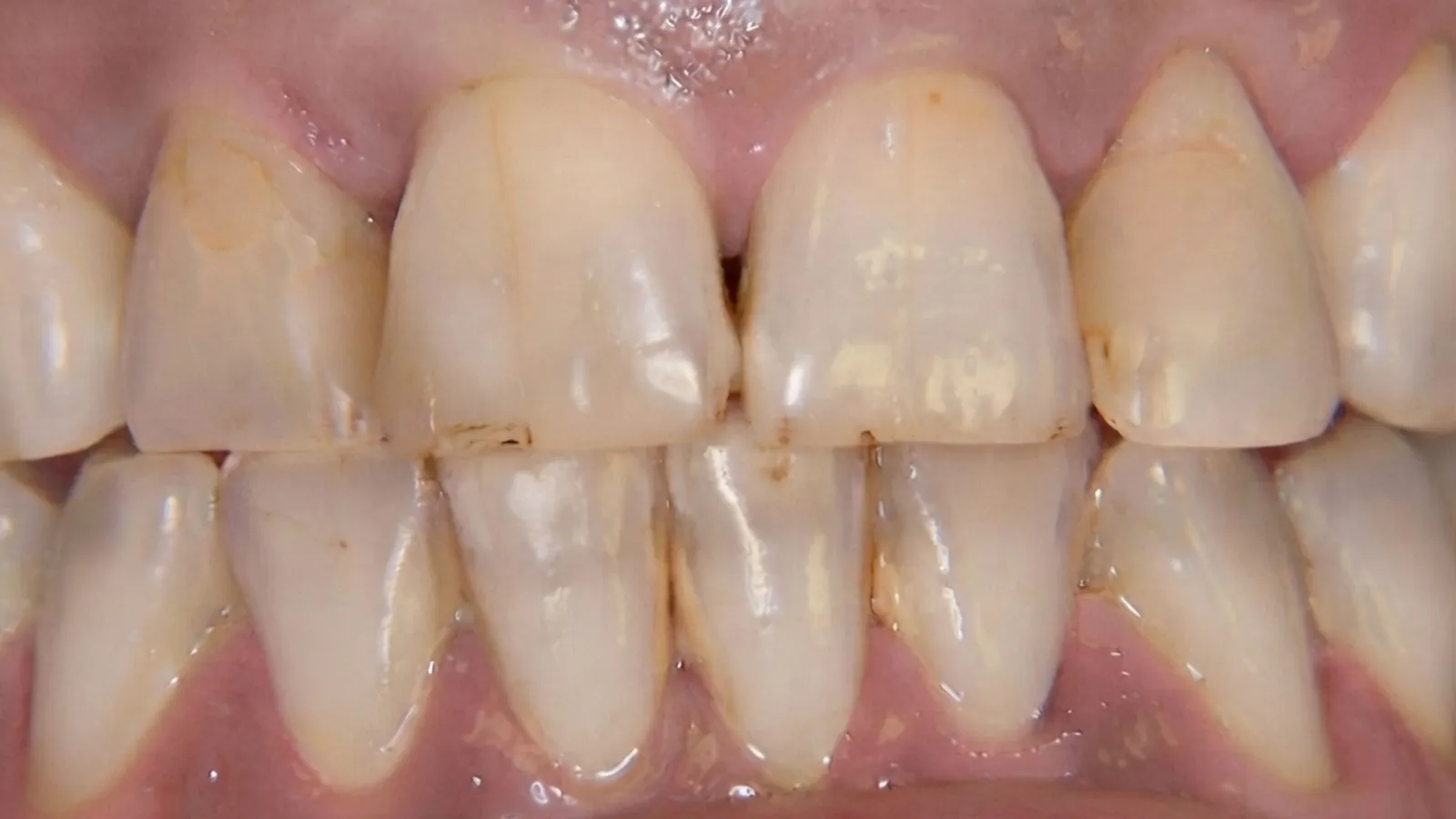 Before dental crowns at Dental & Wellness London, Islington