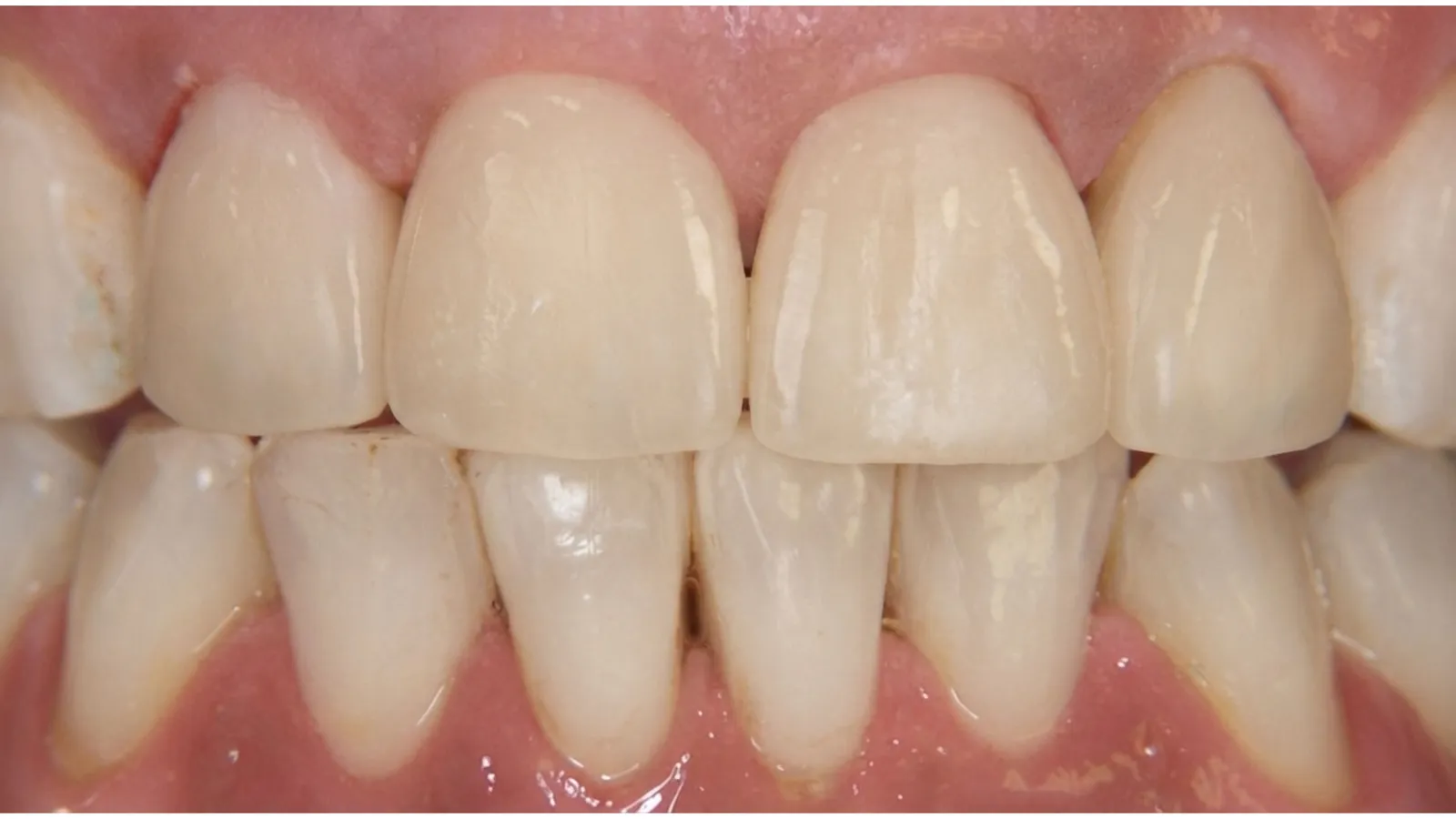 After dental crowns at Dental & Wellness London, Islington