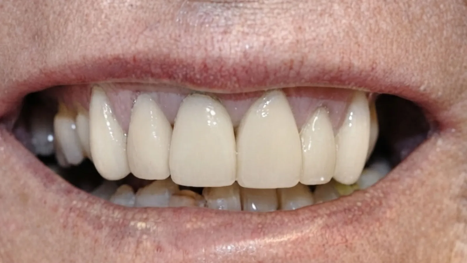 After dental crowns at Dental & Wellness London, Islington