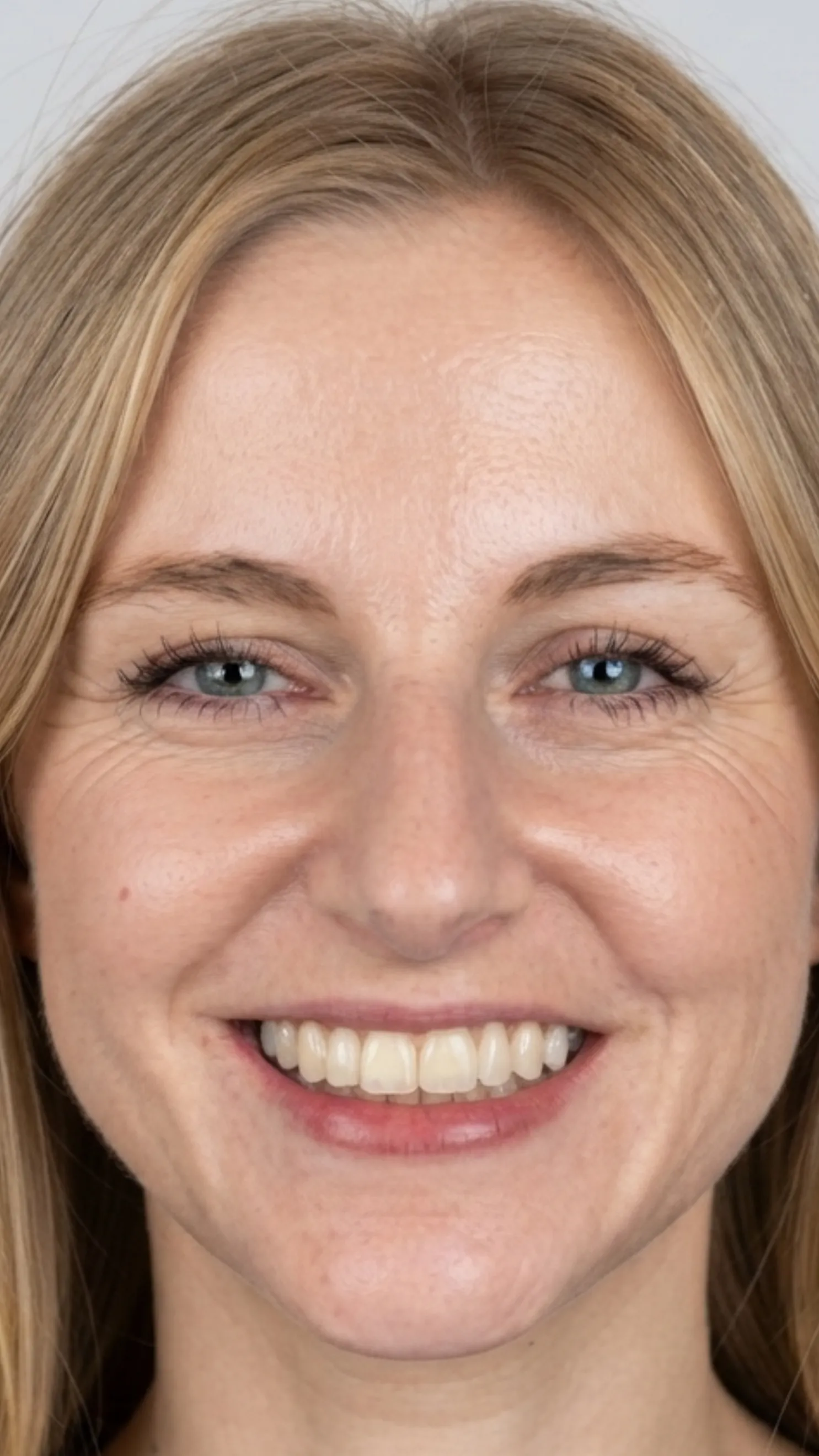 After teeth whitening at Dental & Wellness London, Islington