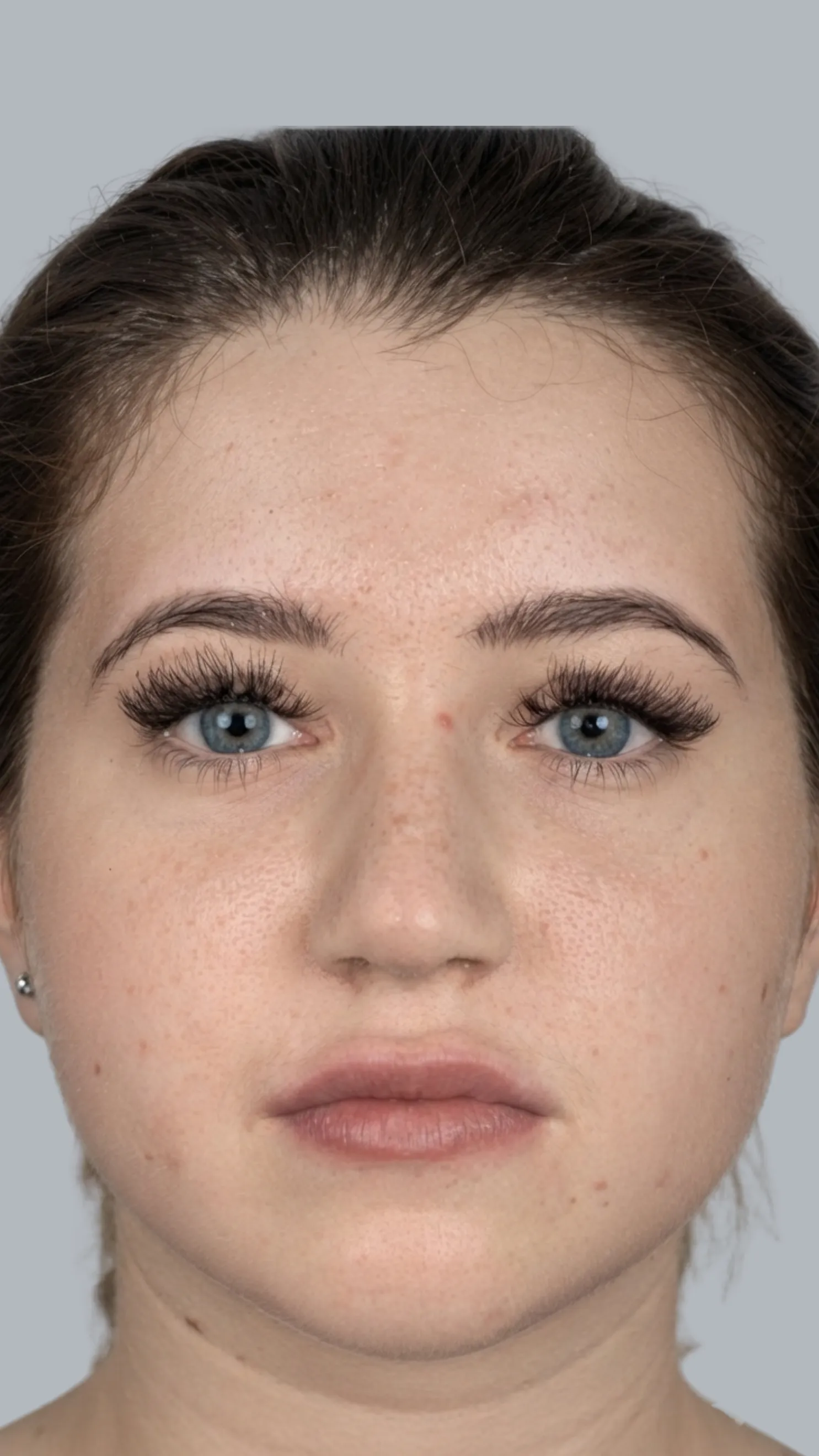 After lip filler at Dental & Wellness London, Islington