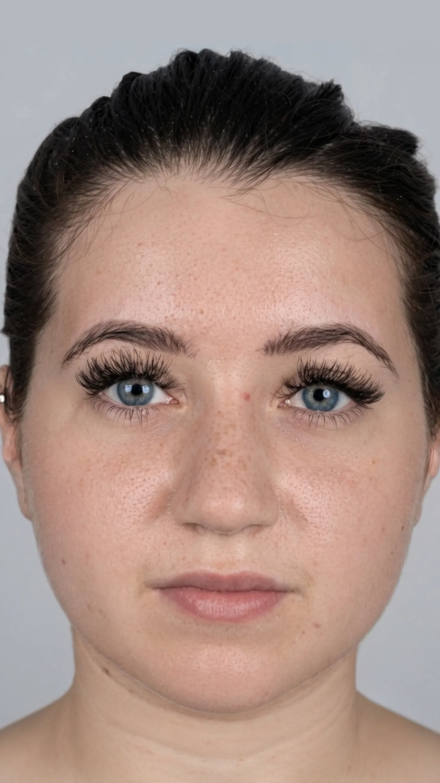 Before lip filler at Dental & Wellness London, Islington