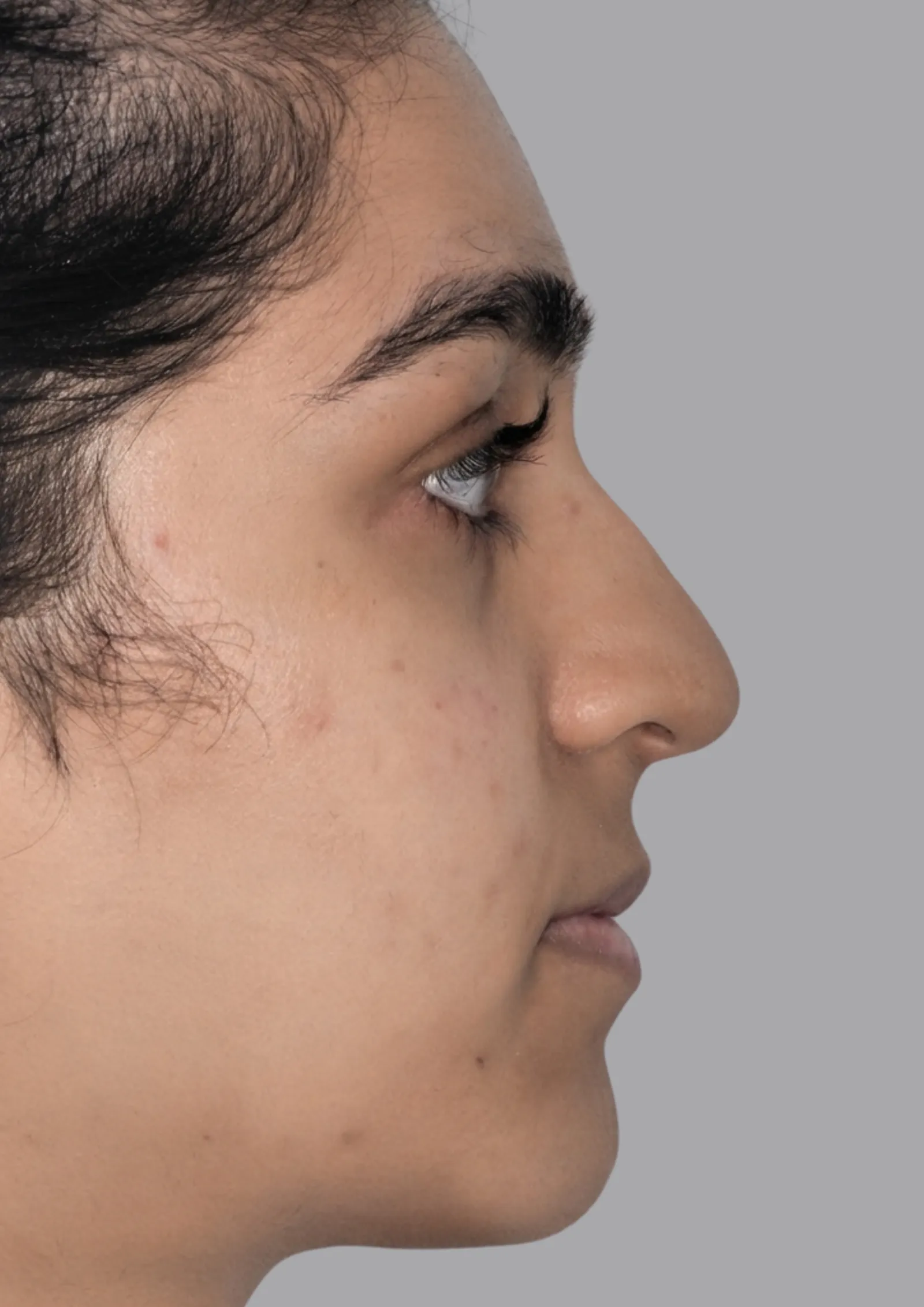 Before dermal filler at Dental & Wellness London, Islington