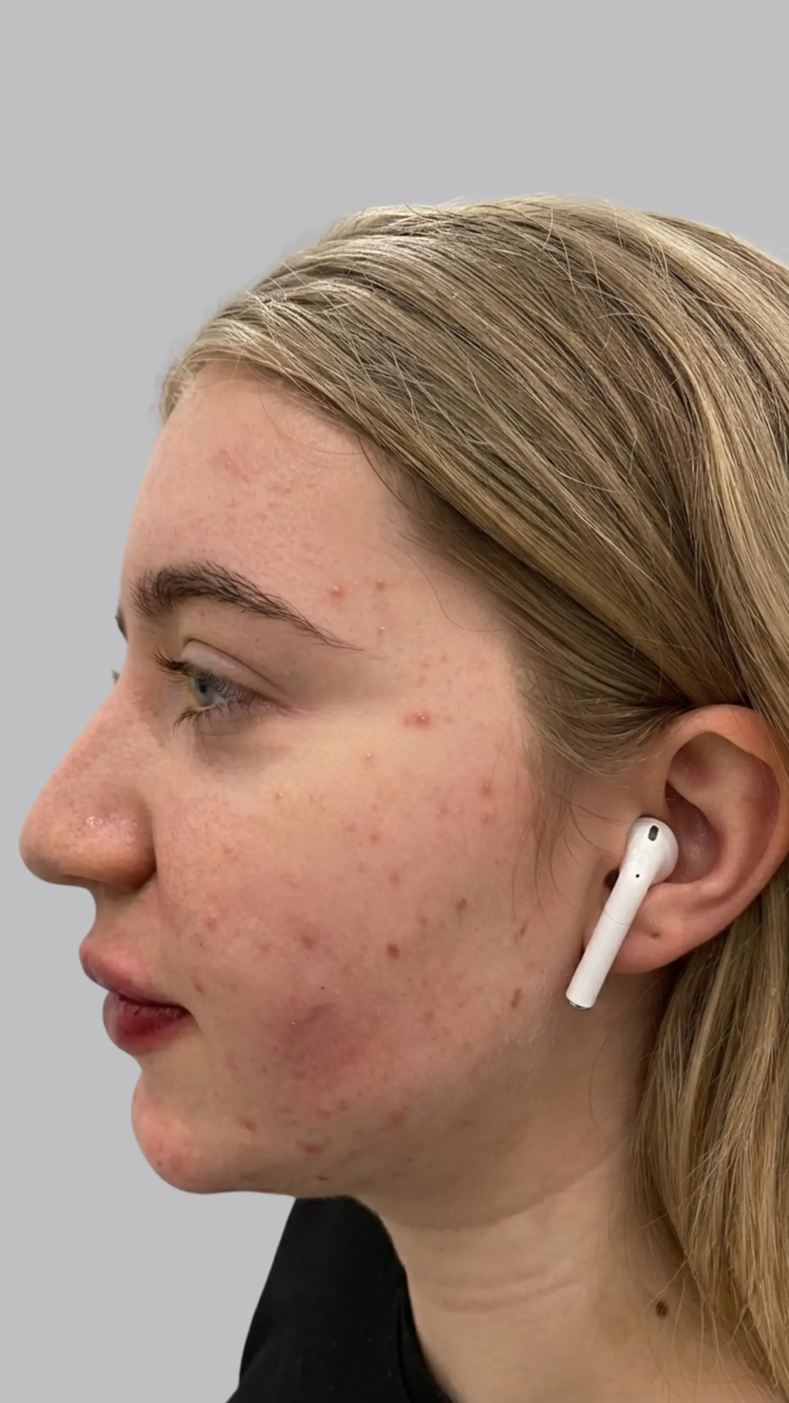 After lip filler at Dental & Wellness London, Islington
