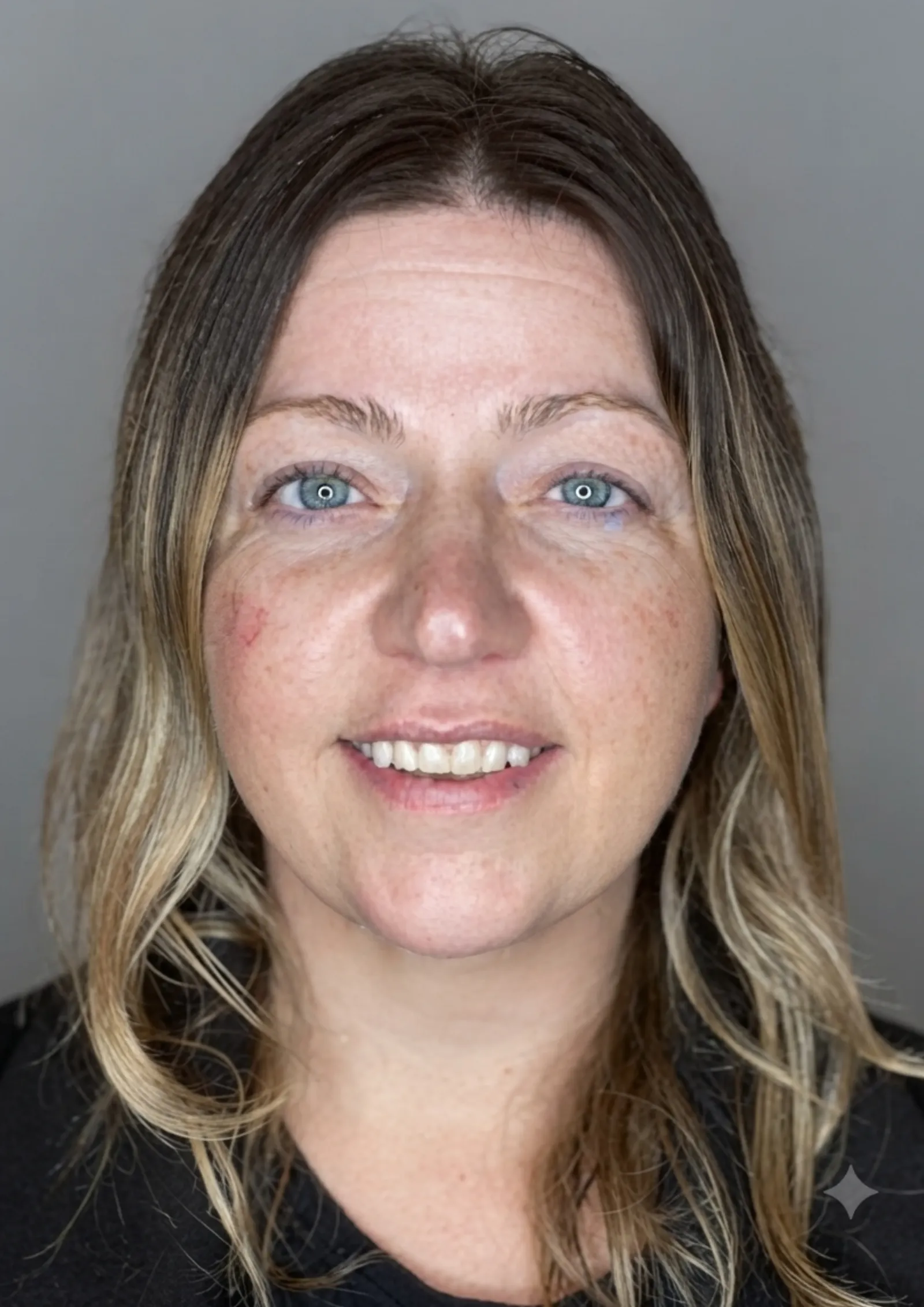 Before dermal filler at Dental & Wellness London, Islington