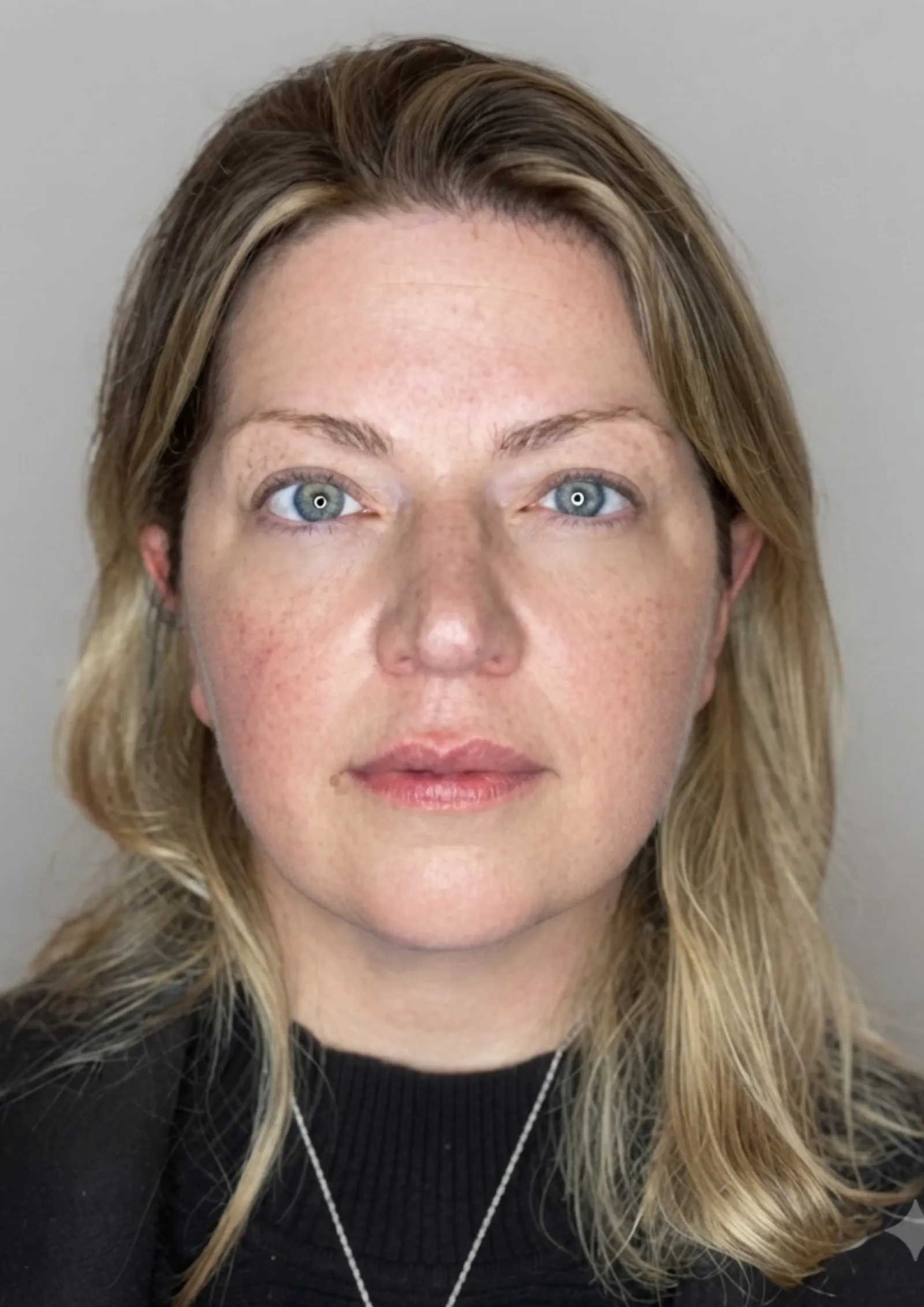 After dermal filler at Dental & Wellness London, Islington