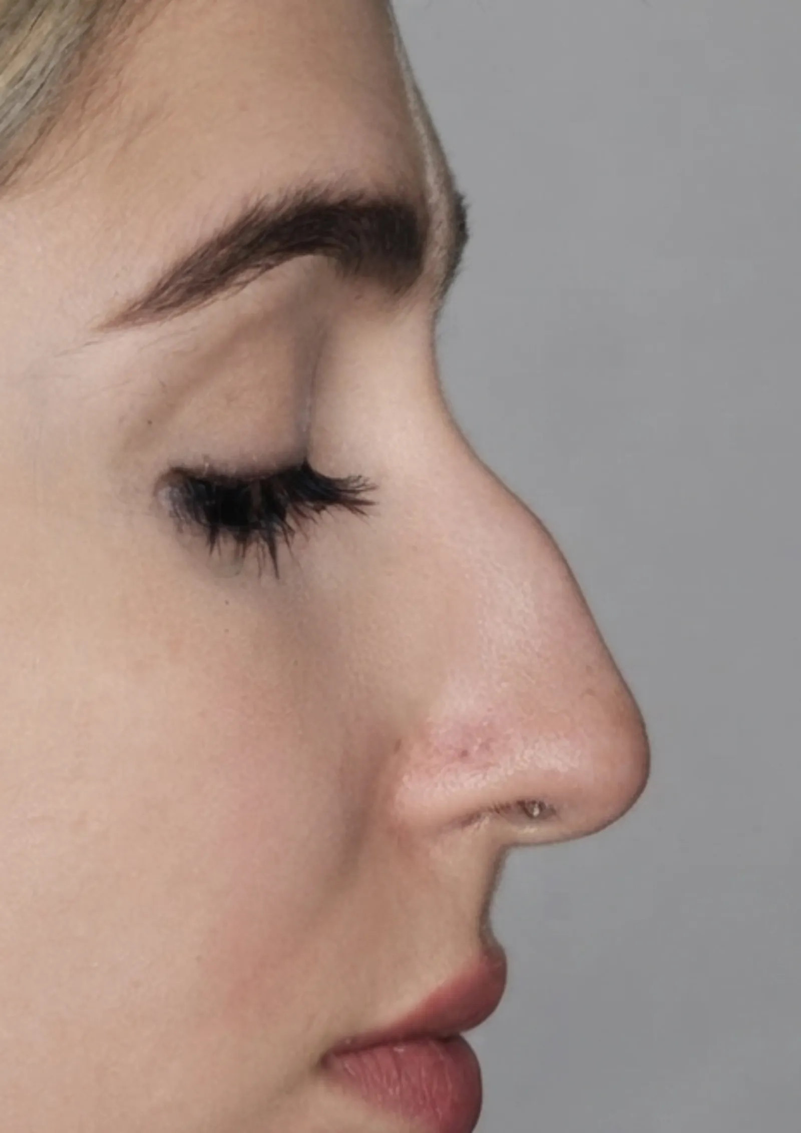 Before dermal filler at Dental & Wellness London, Islington