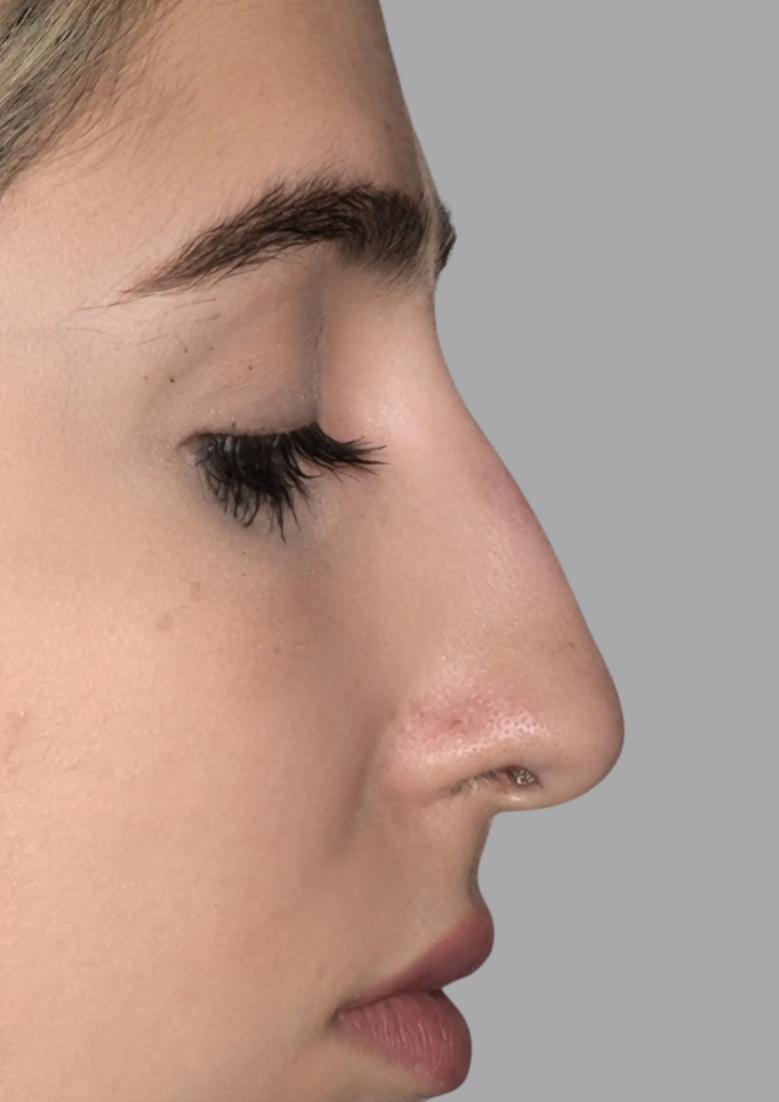 After dermal filler at Dental & Wellness London, Islington