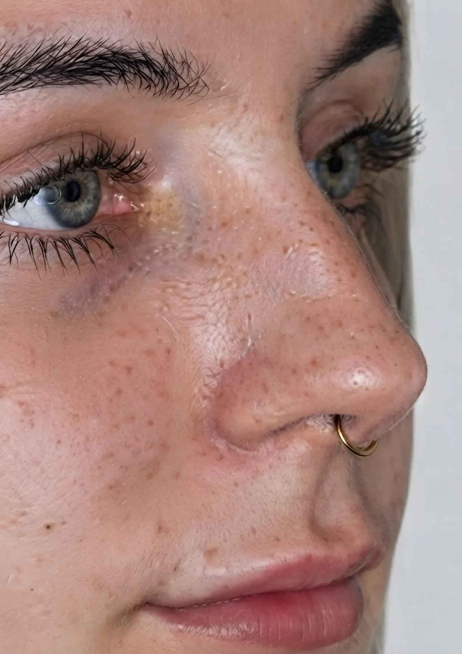 Before dermal filler at Dental & Wellness London, Islington