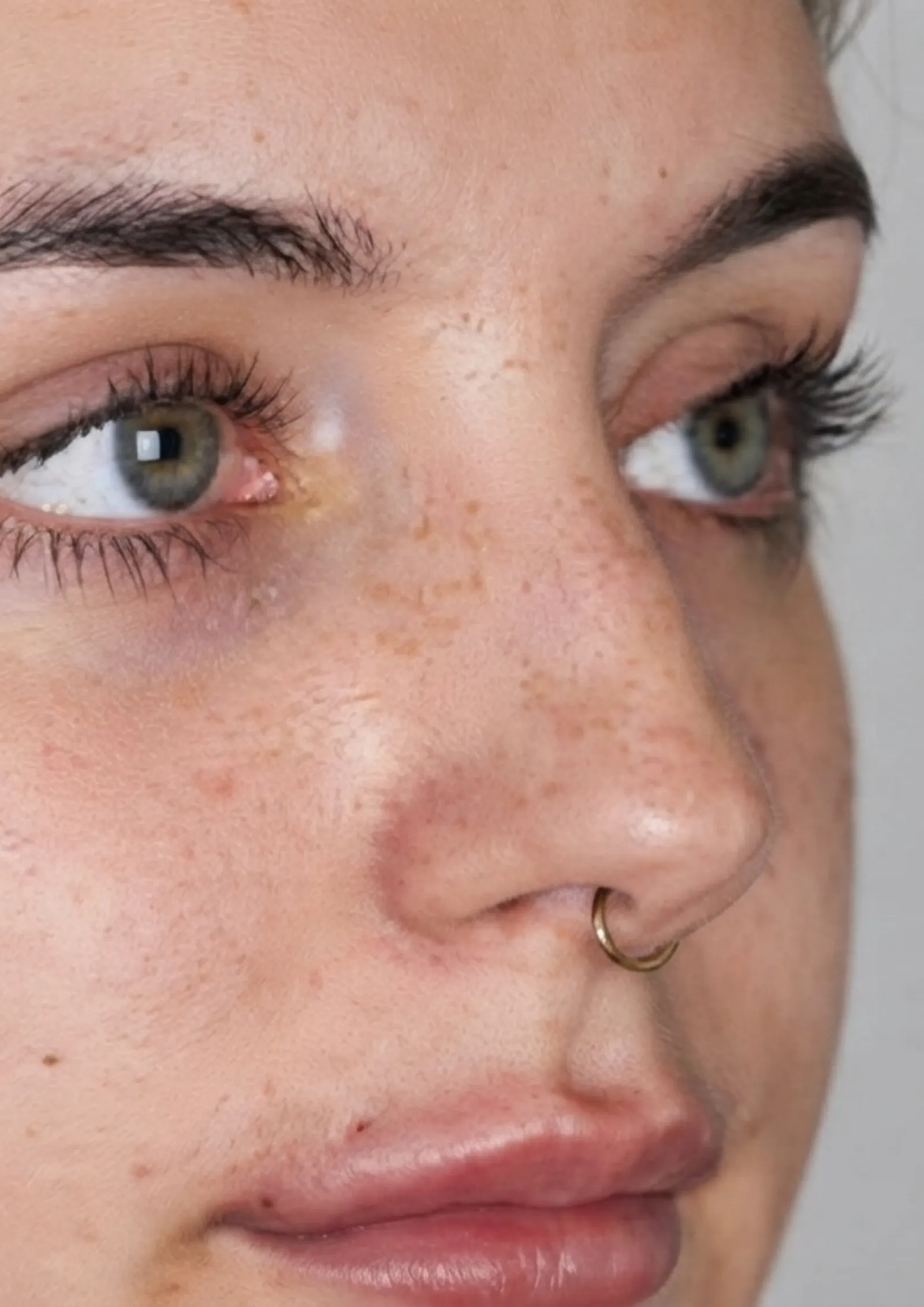 After dermal filler at Dental & Wellness London, Islington