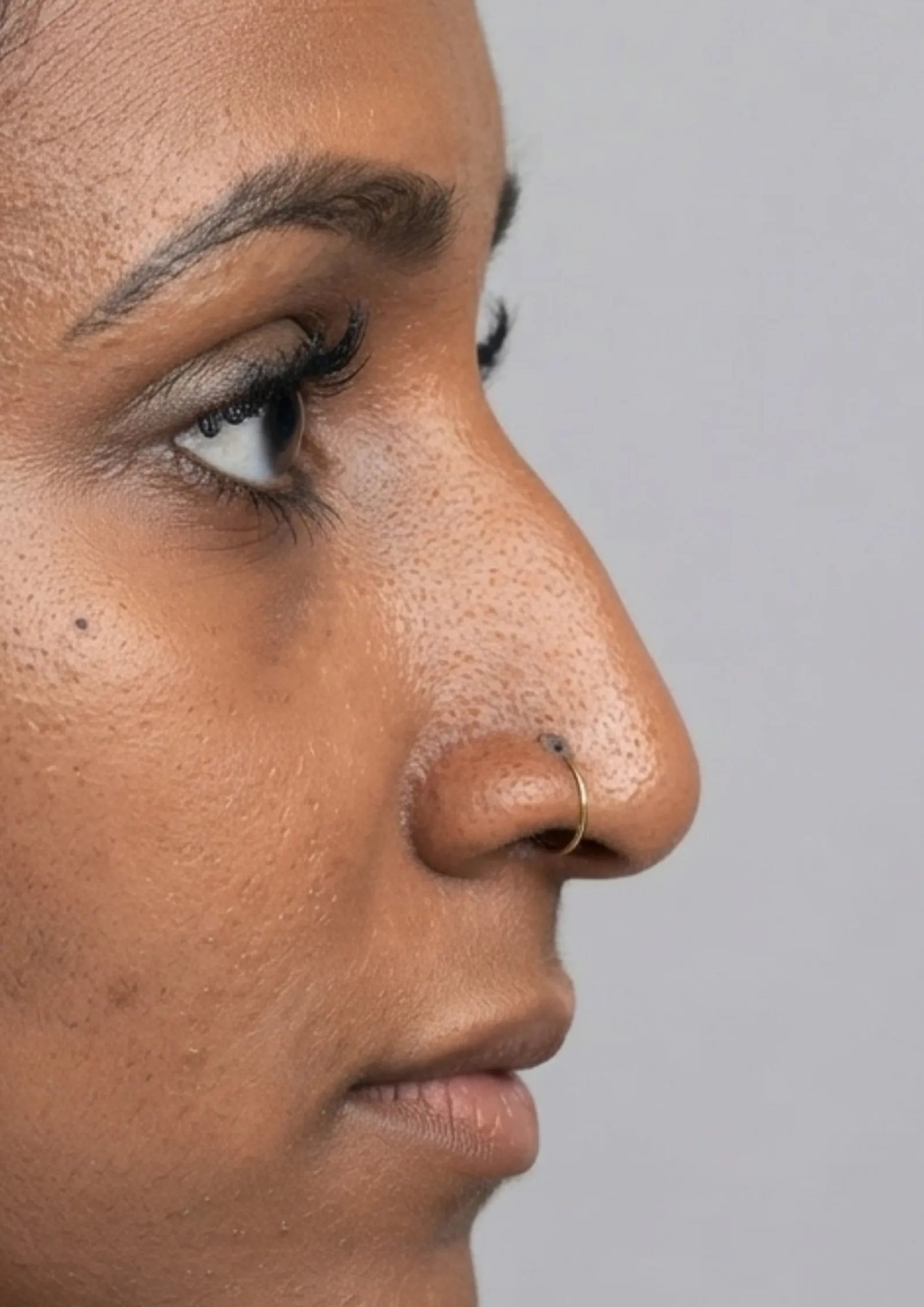 Before dermal filler at Dental & Wellness London, Islington
