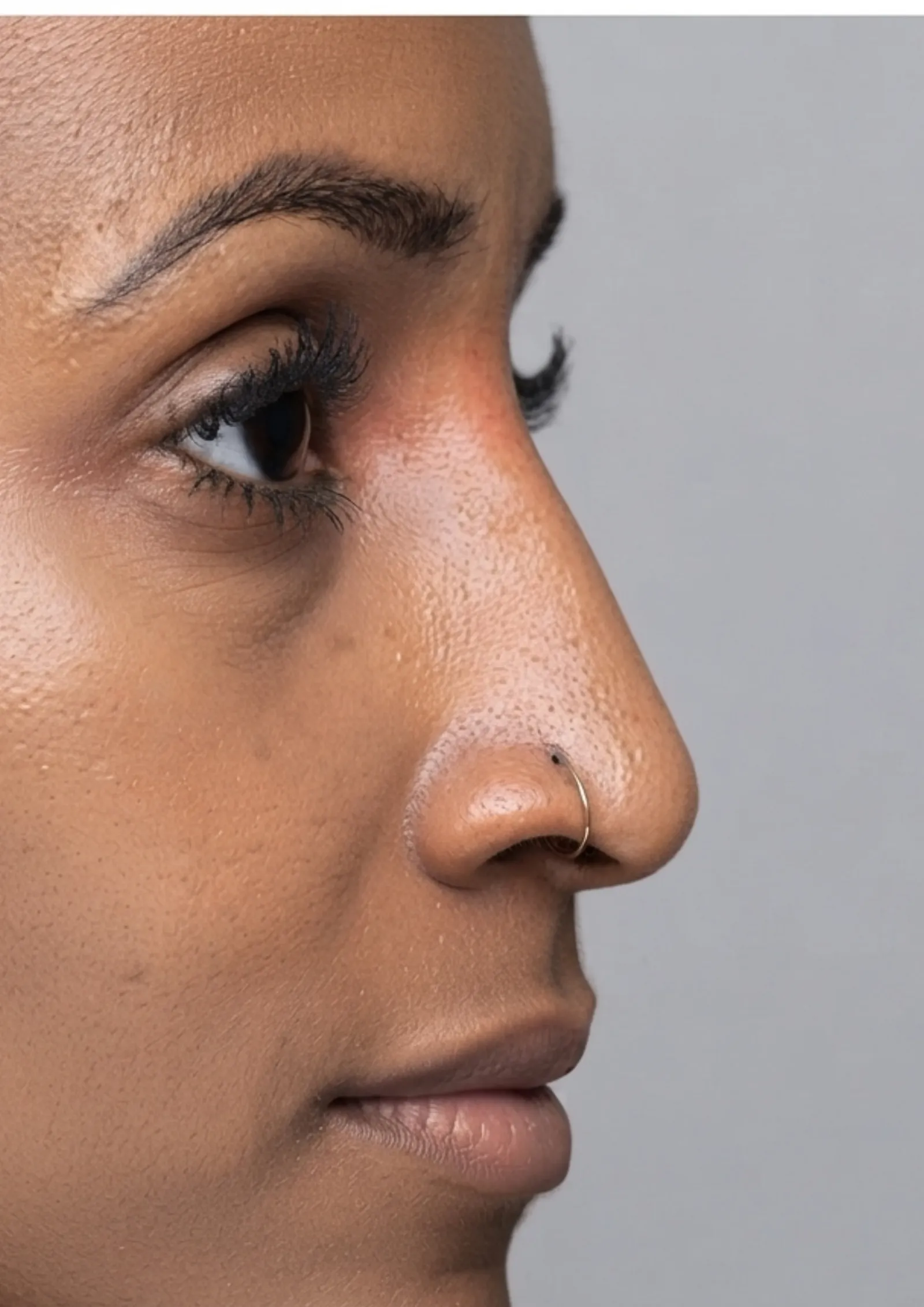 After dermal filler at Dental & Wellness London, Islington