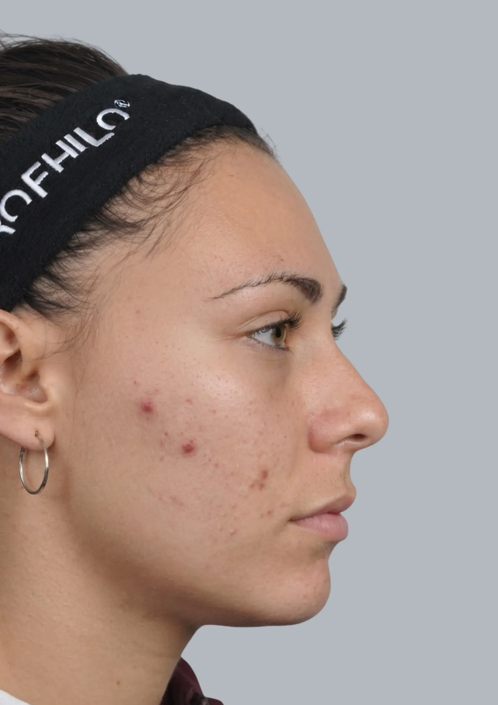 Before acne treatment at Dental & Wellness London, Islington