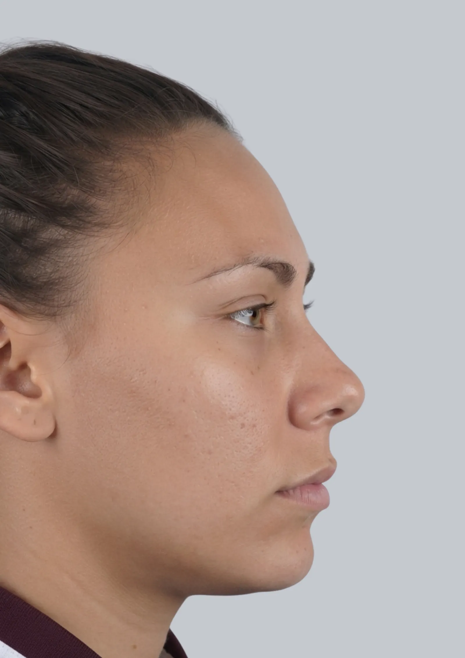 After acne treatment at Dental & Wellness London, Islington