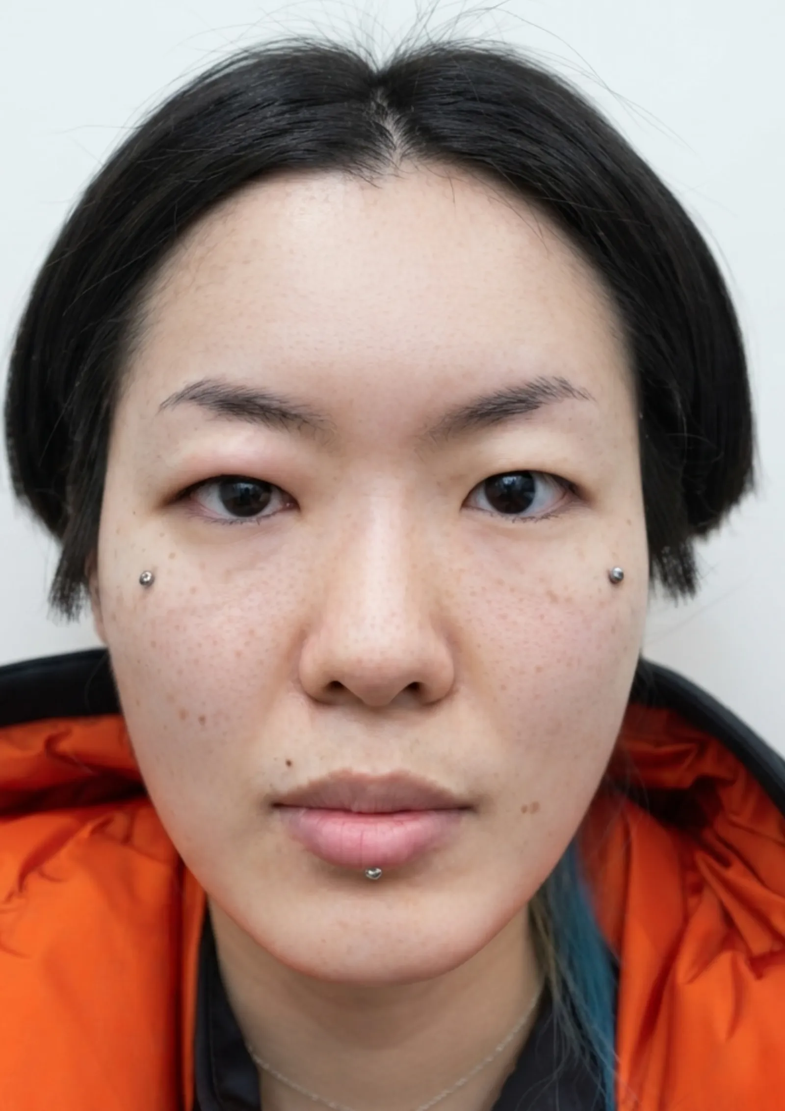 Before acne treatment at Dental & Wellness London, Islington