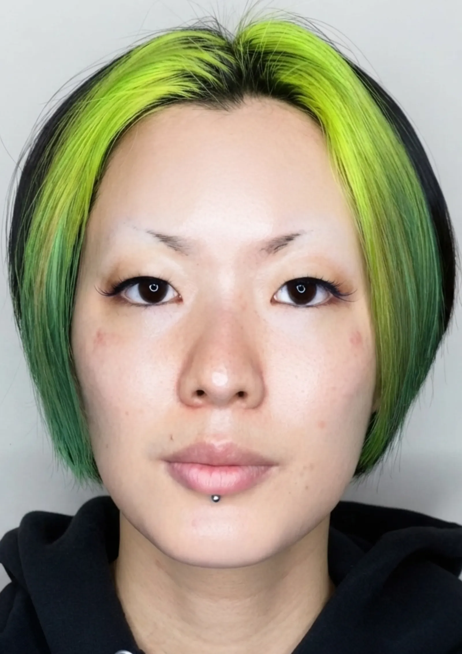 After acne treatment at Dental & Wellness London, Islington
