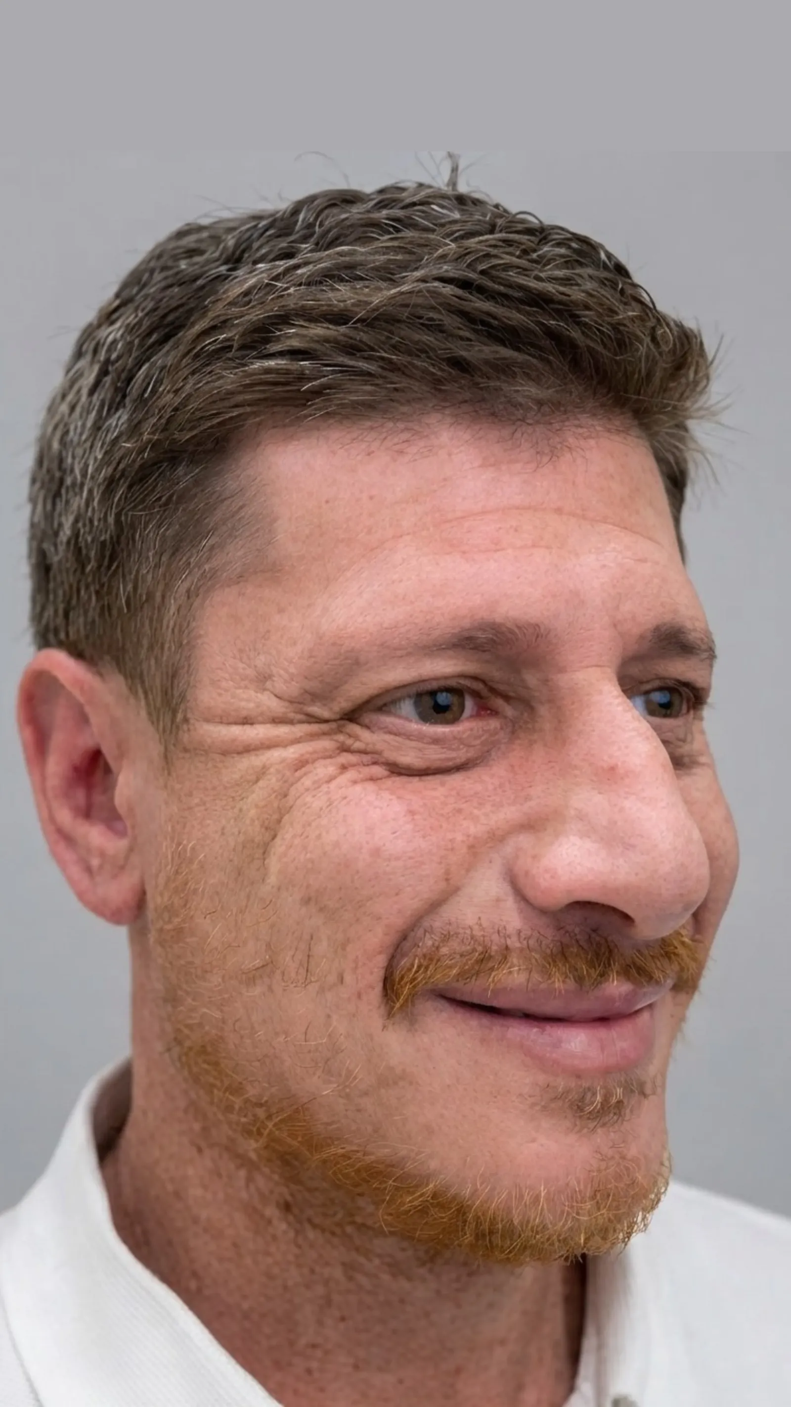 Before anti-wrinkle treatment at Dental & Wellness London, Islington