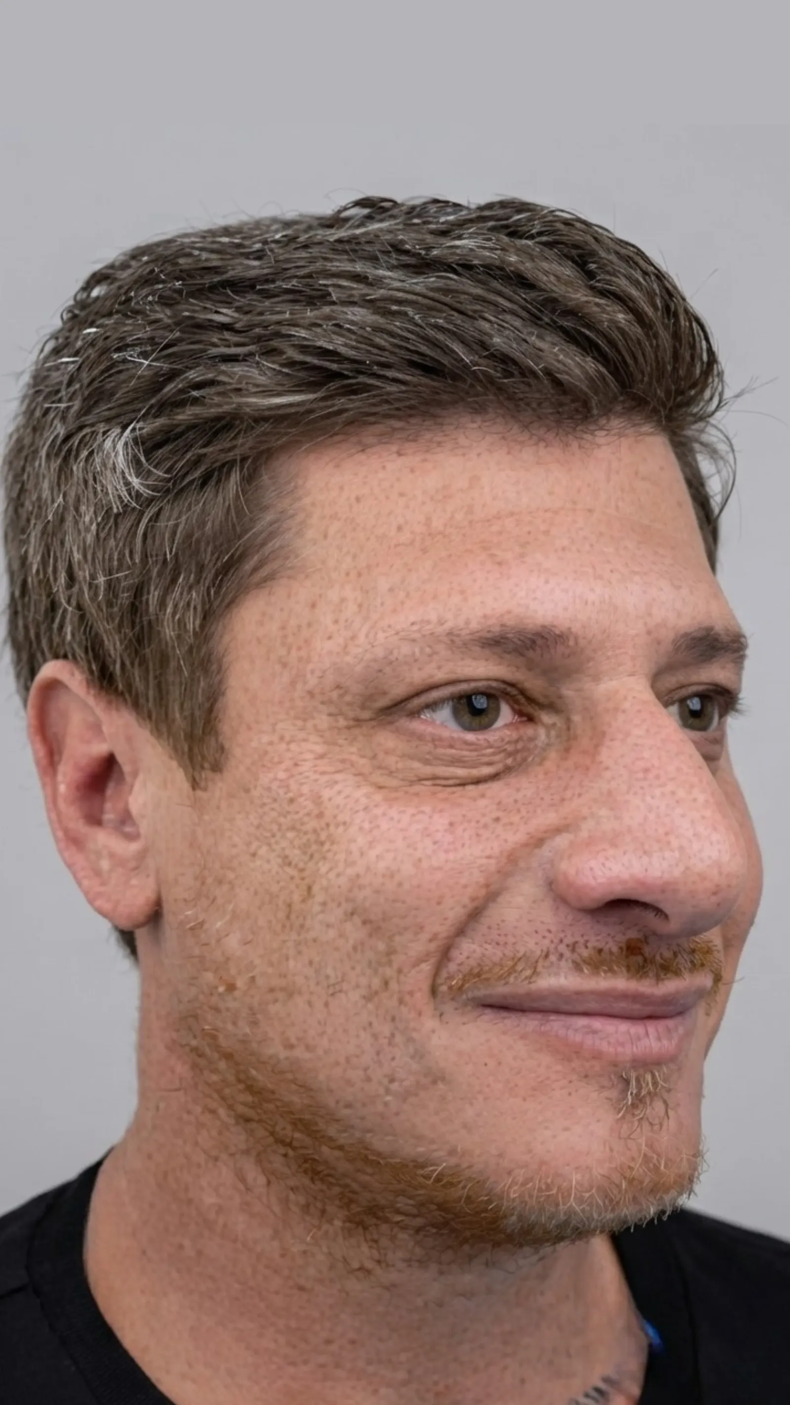 After anti-wrinkle treatment at Dental & Wellness London, Islington