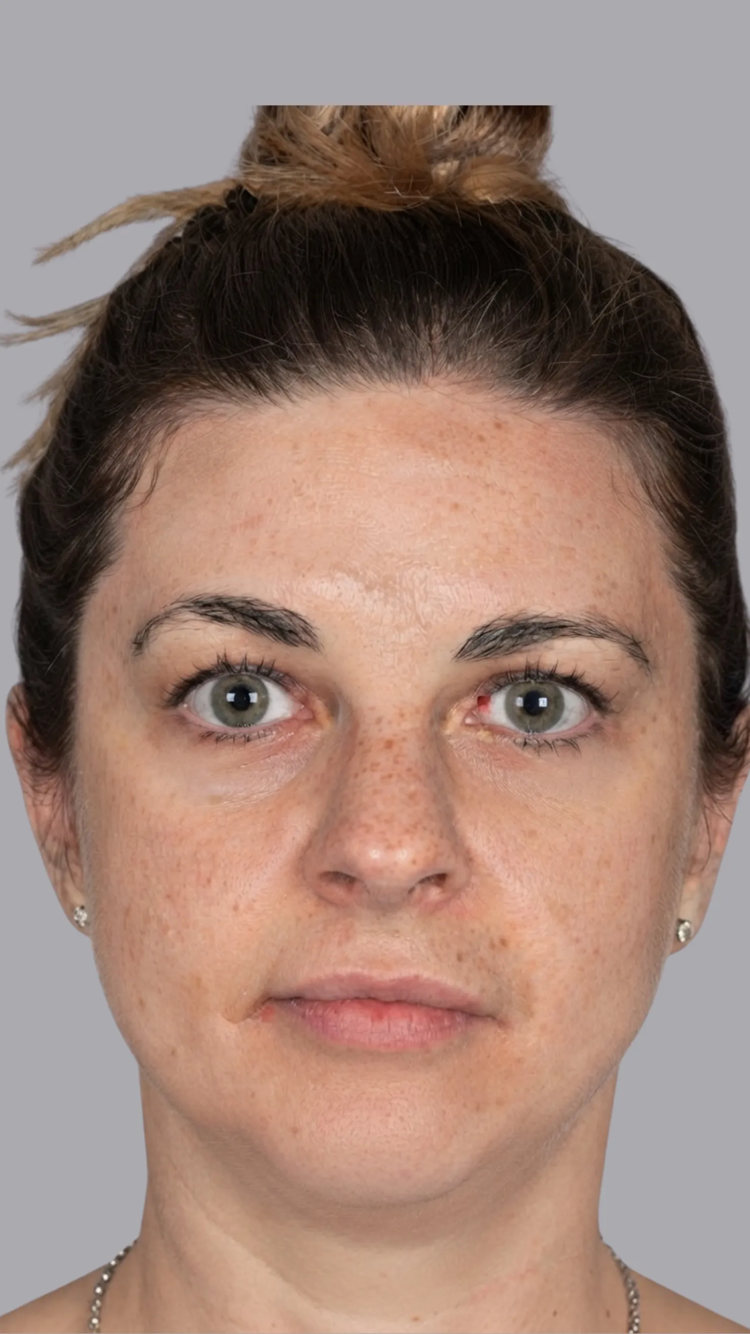 Before tear trough filler at Dental & Wellness London, Islington