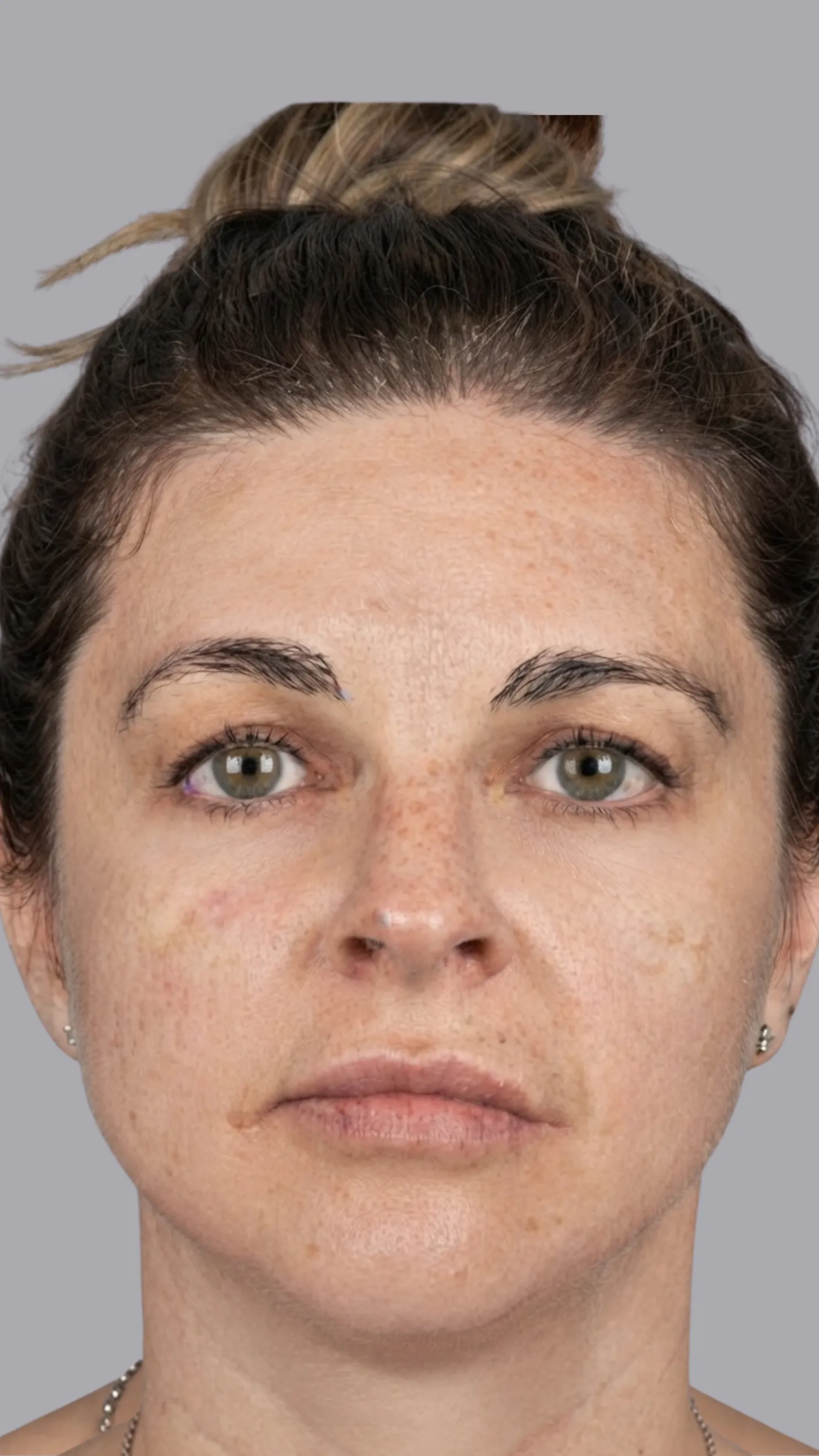After tear trough filler at Dental & Wellness London, Islington