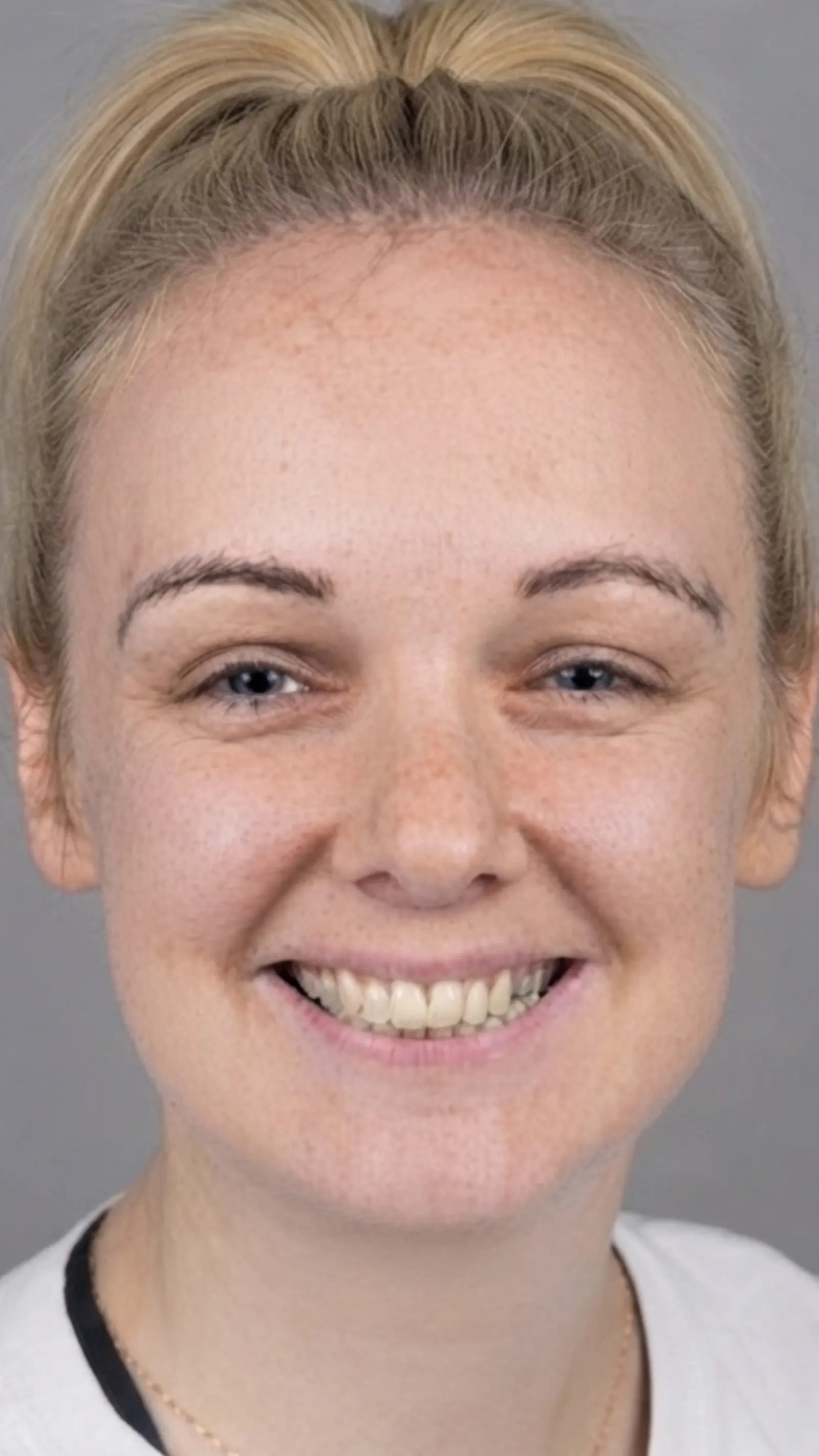 Before fixed braces at Dental & Wellness London, Islington