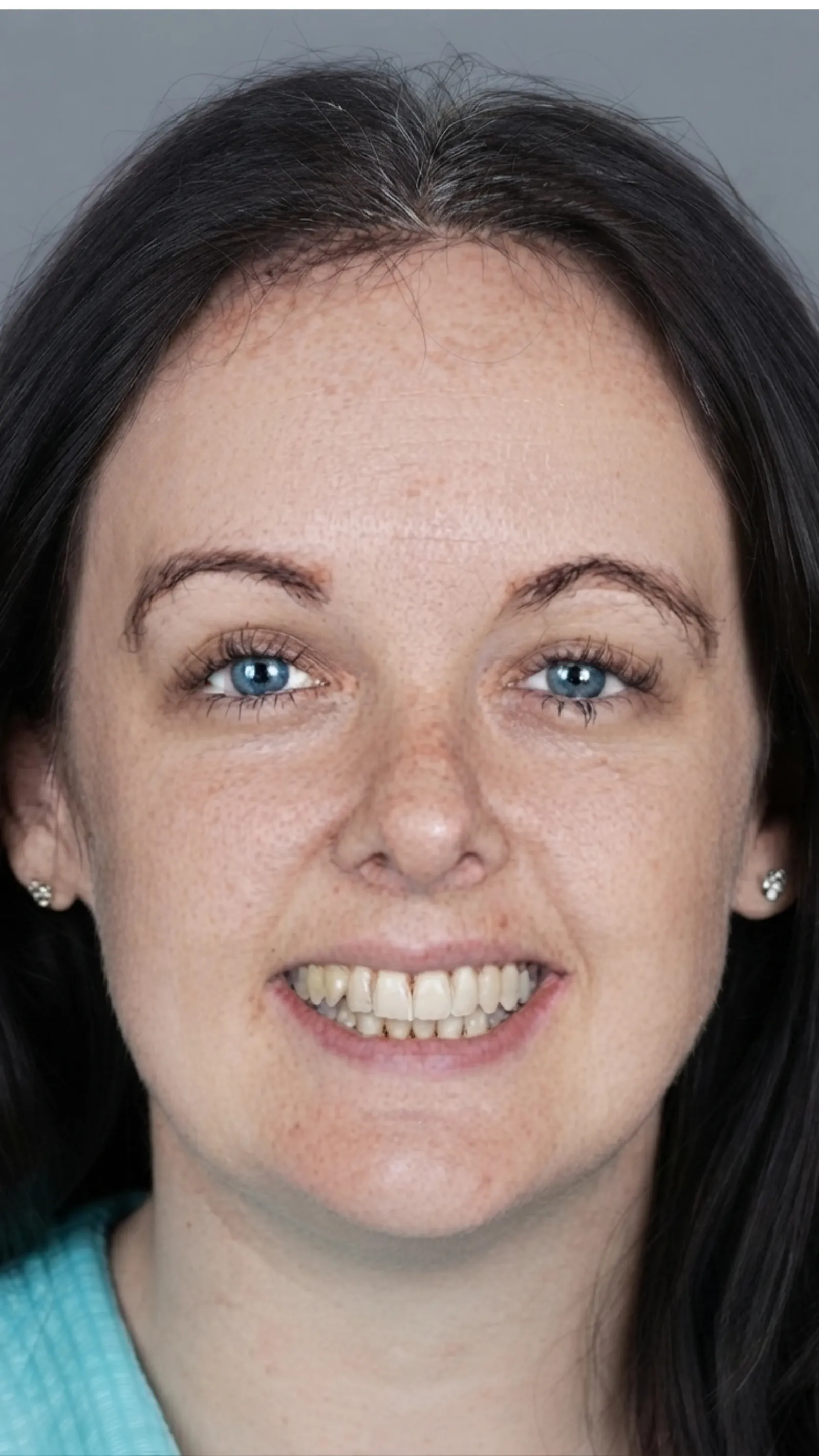 After fixed braces at Dental & Wellness London, Islington