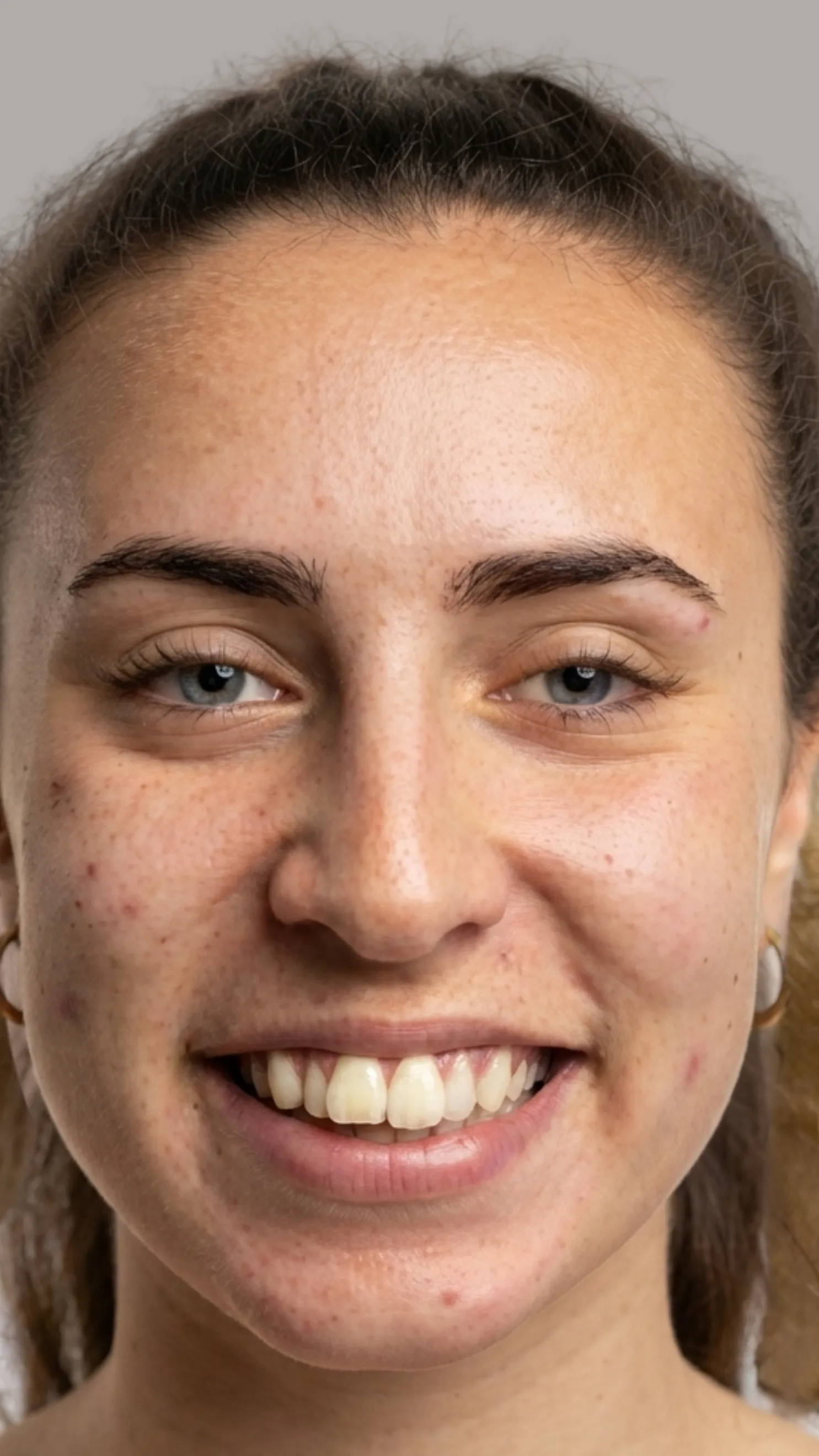 Before Invisalign at Dental & Wellness London, Islington