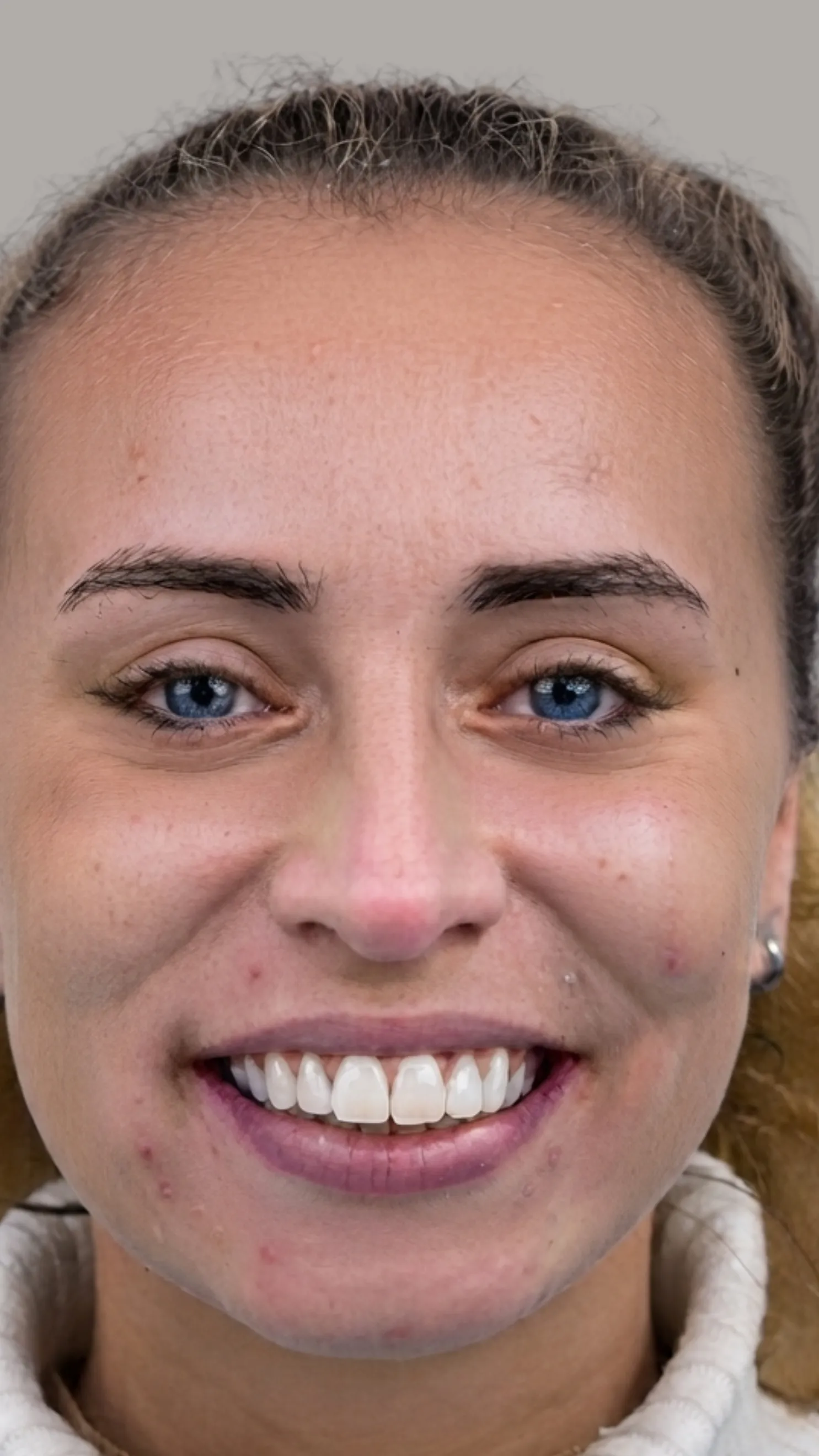 After Invisalign at Dental & Wellness London, Islington