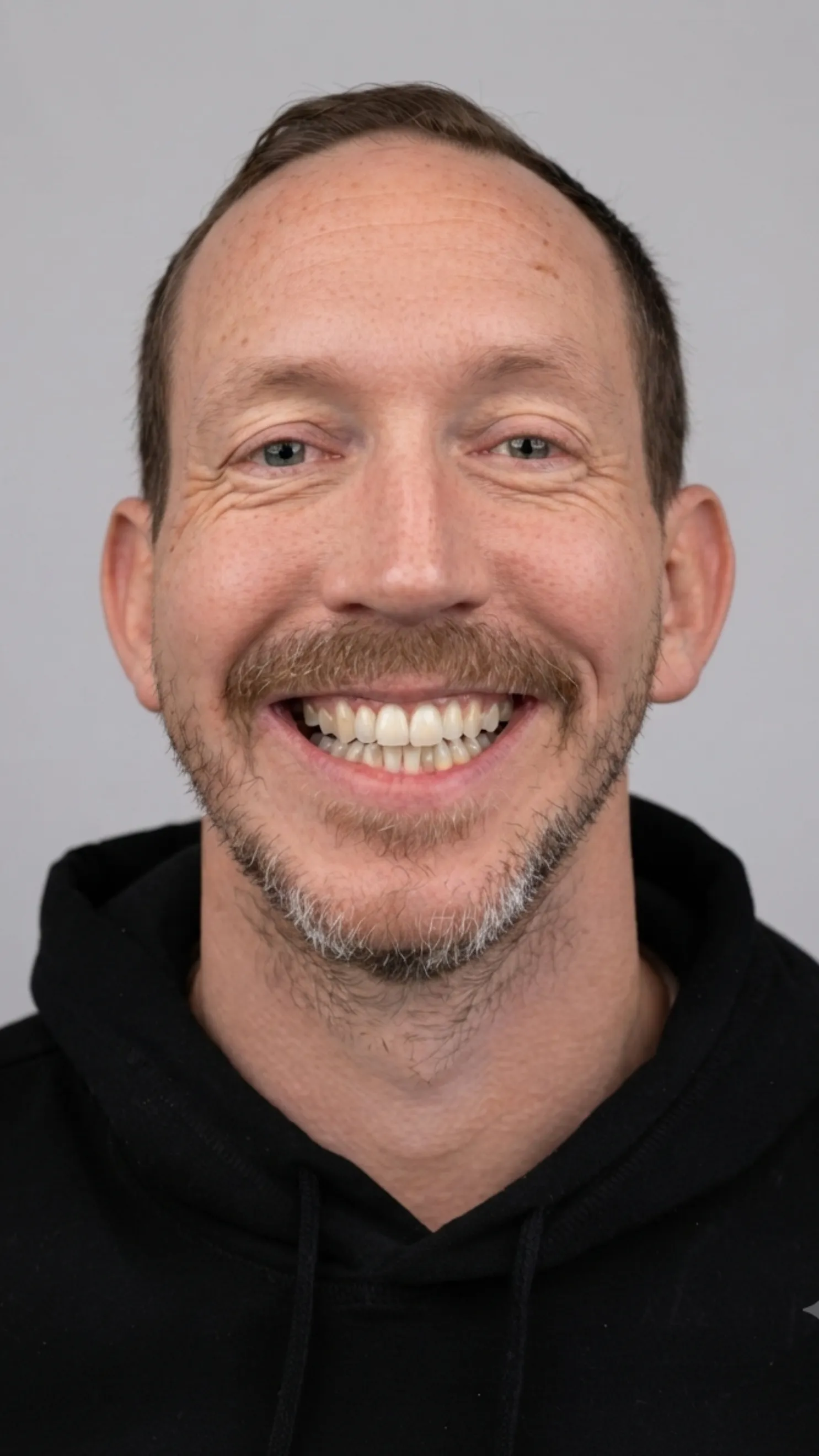 Before Invisalign at Dental & Wellness London, Islington