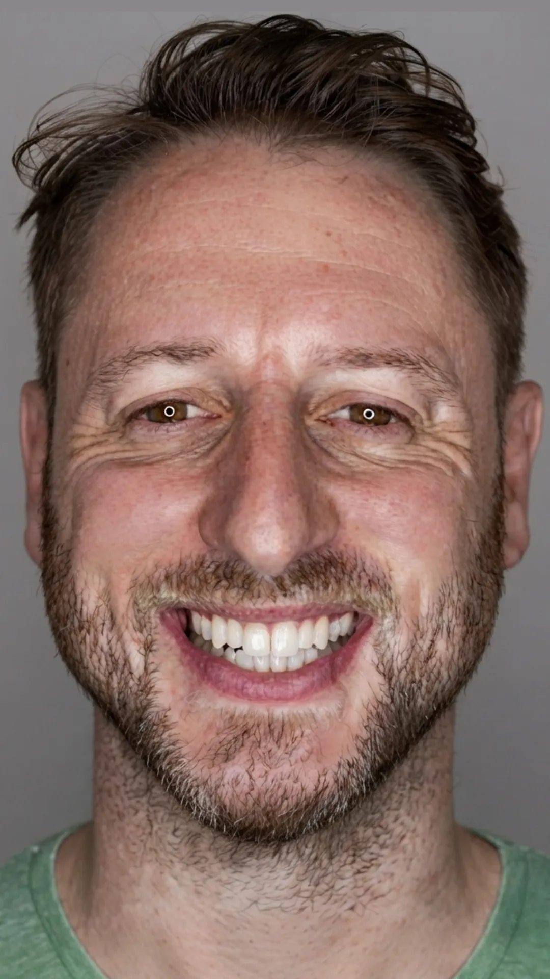 After Invisalign at Dental & Wellness London, Islington