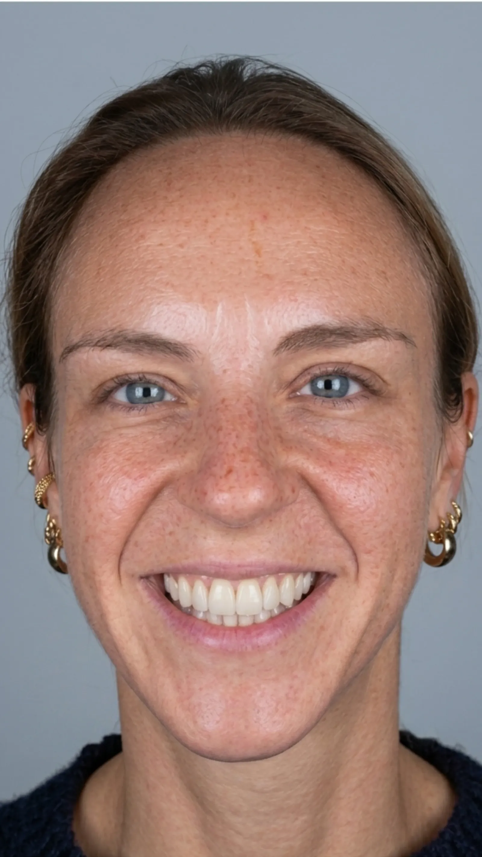 After dental bonding at Dental & Wellness London, Islington