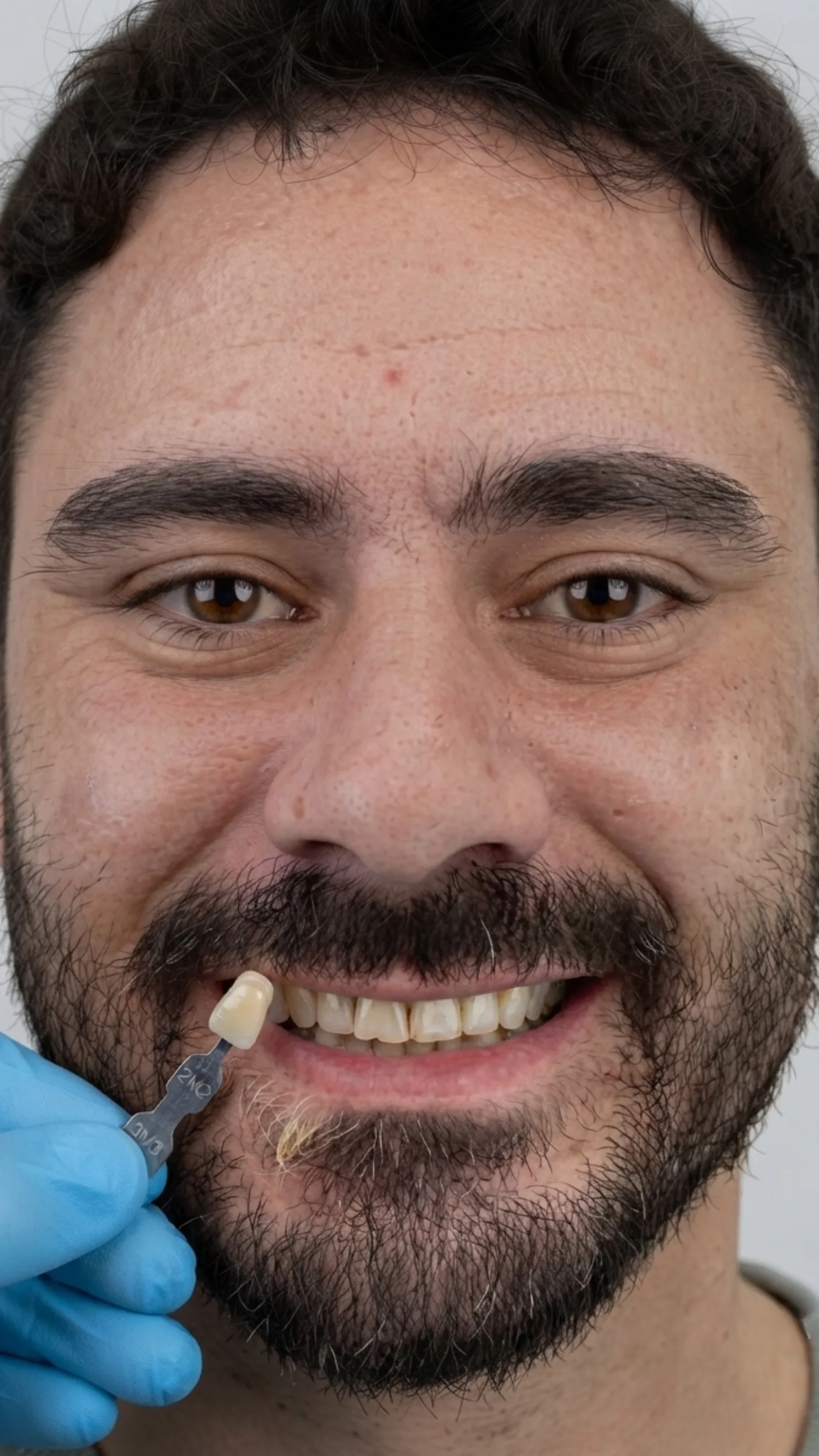 Before teeth whitening at Dental & Wellness London, Islington