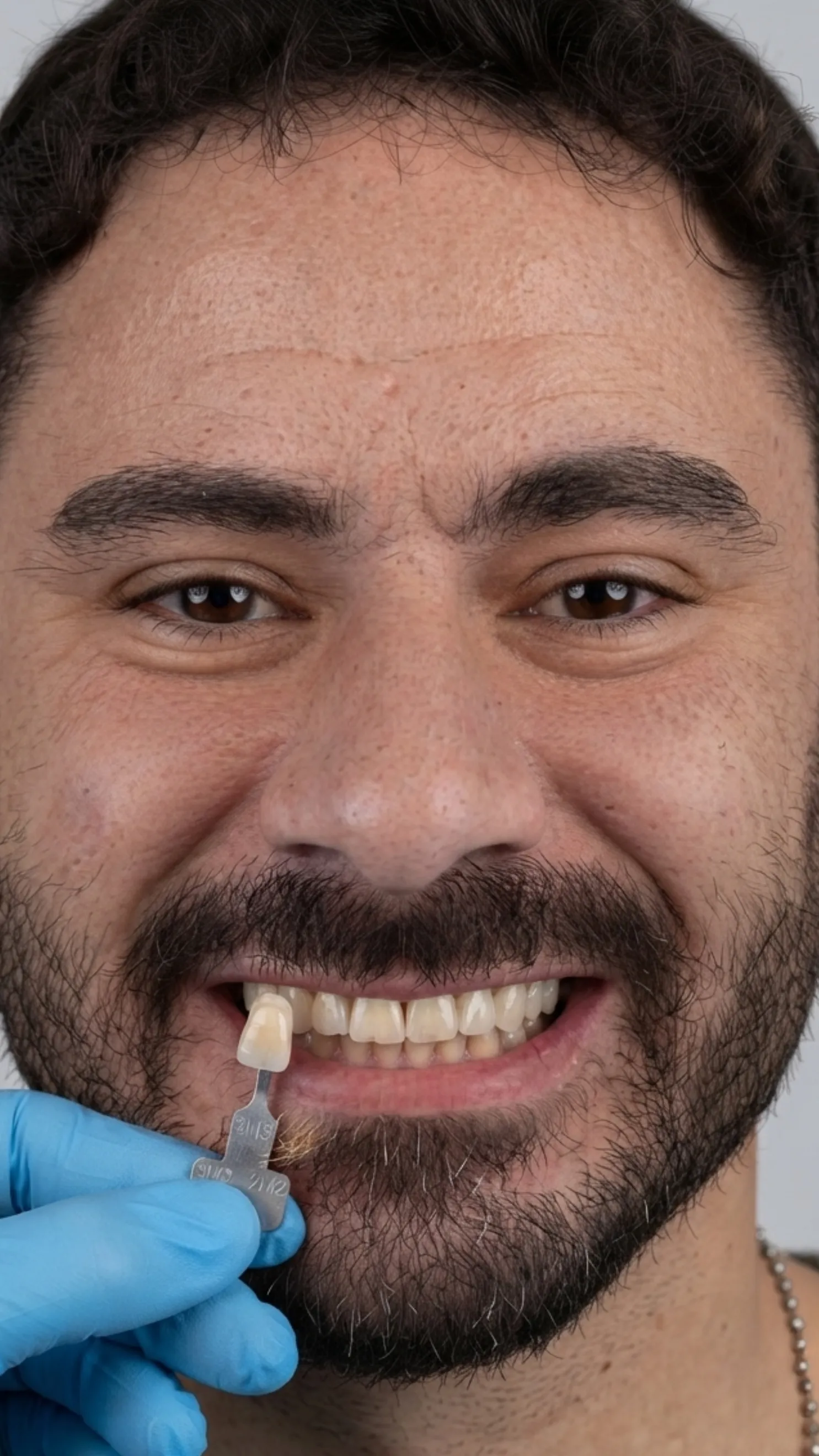After teeth whitening at Dental & Wellness London, Islington
