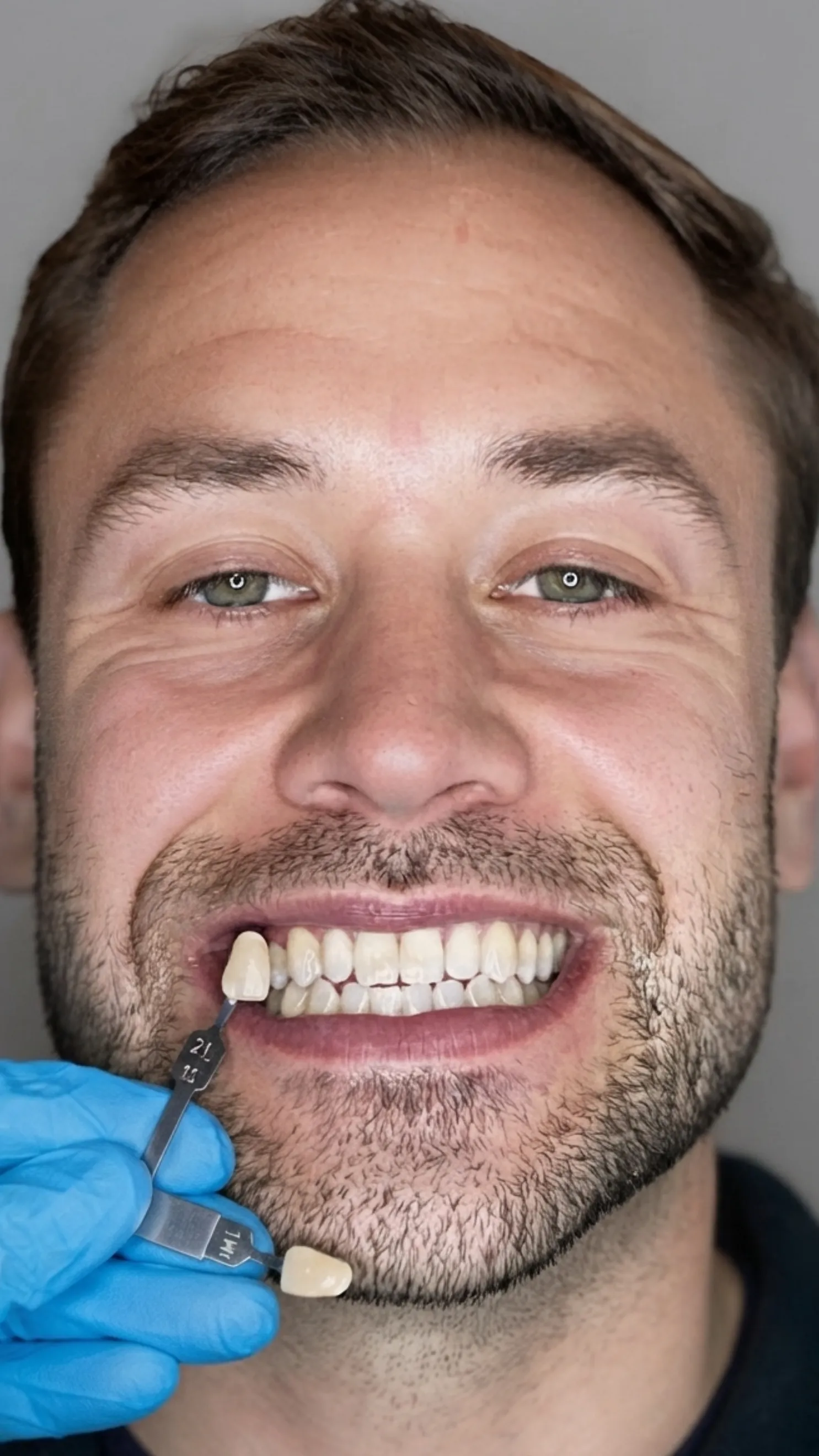 After teeth whitening at Dental & Wellness London, Islington