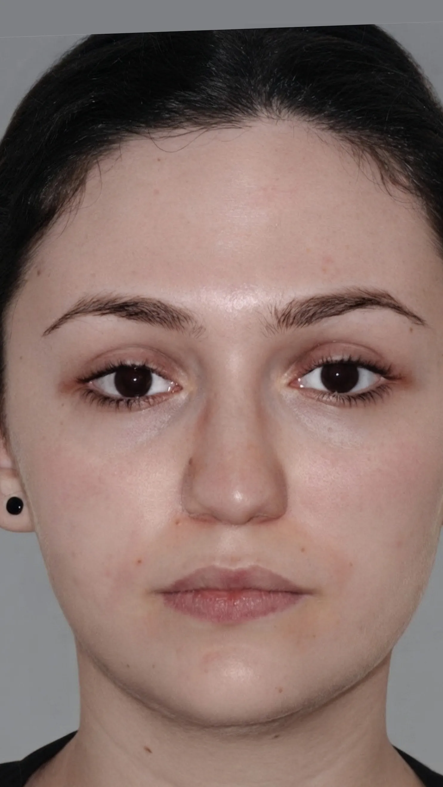 Before tear trough filler at Dental & Wellness London, Islington