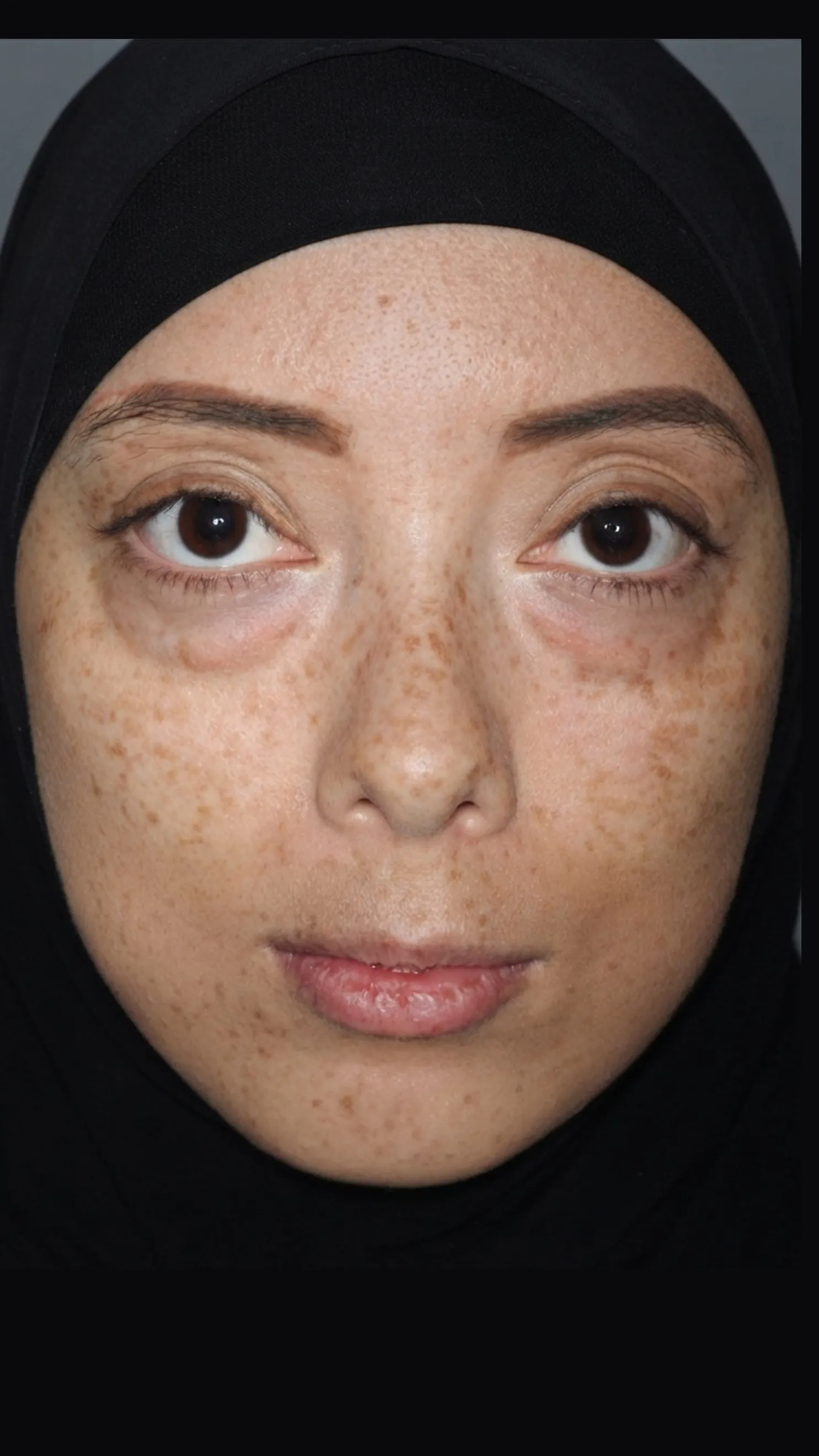Before tear trough filler at Dental & Wellness London, Islington