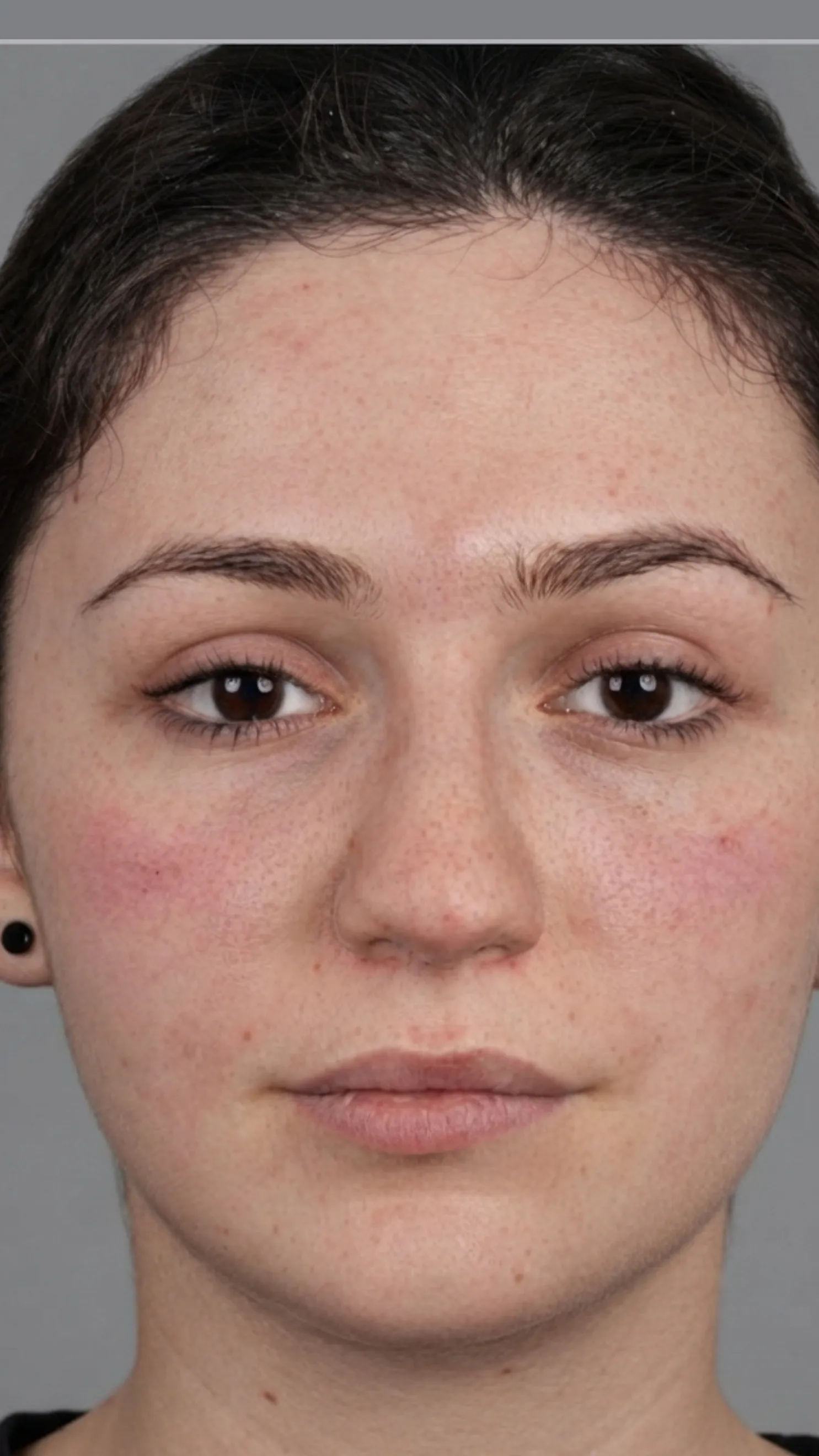 After tear trough filler at Dental & Wellness London, Islington