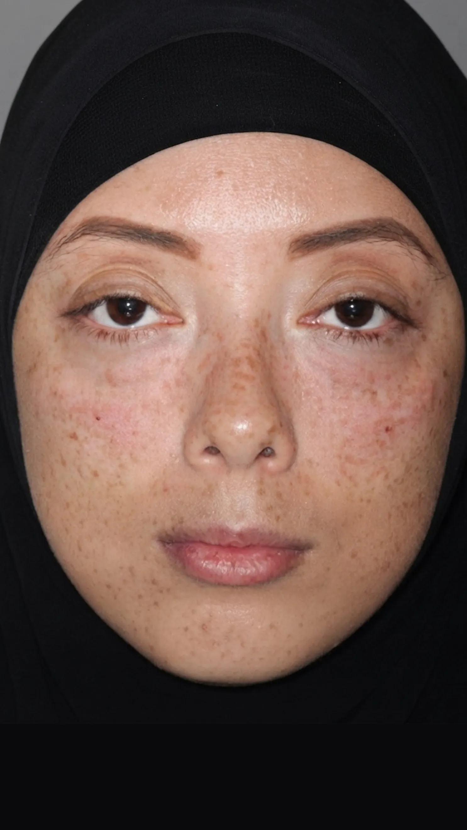 After tear trough filler at Dental & Wellness London, Islington