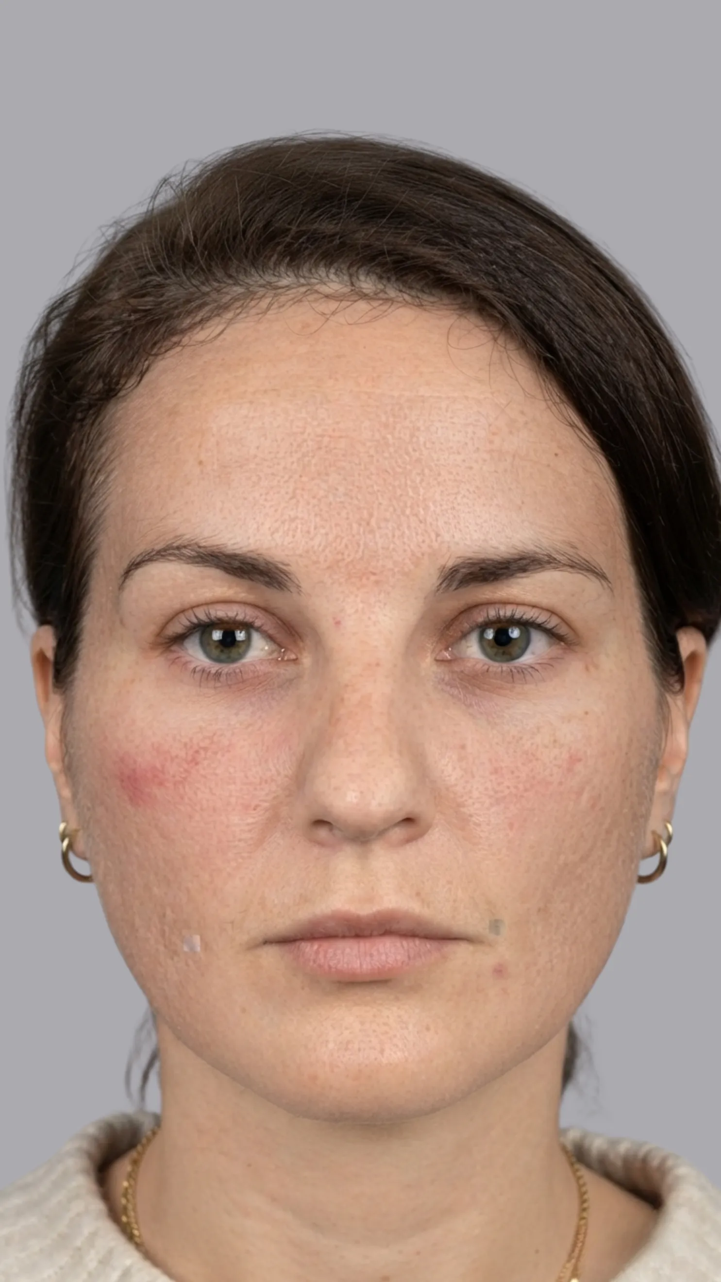 Before tear trough filler at Dental & Wellness London, Islington