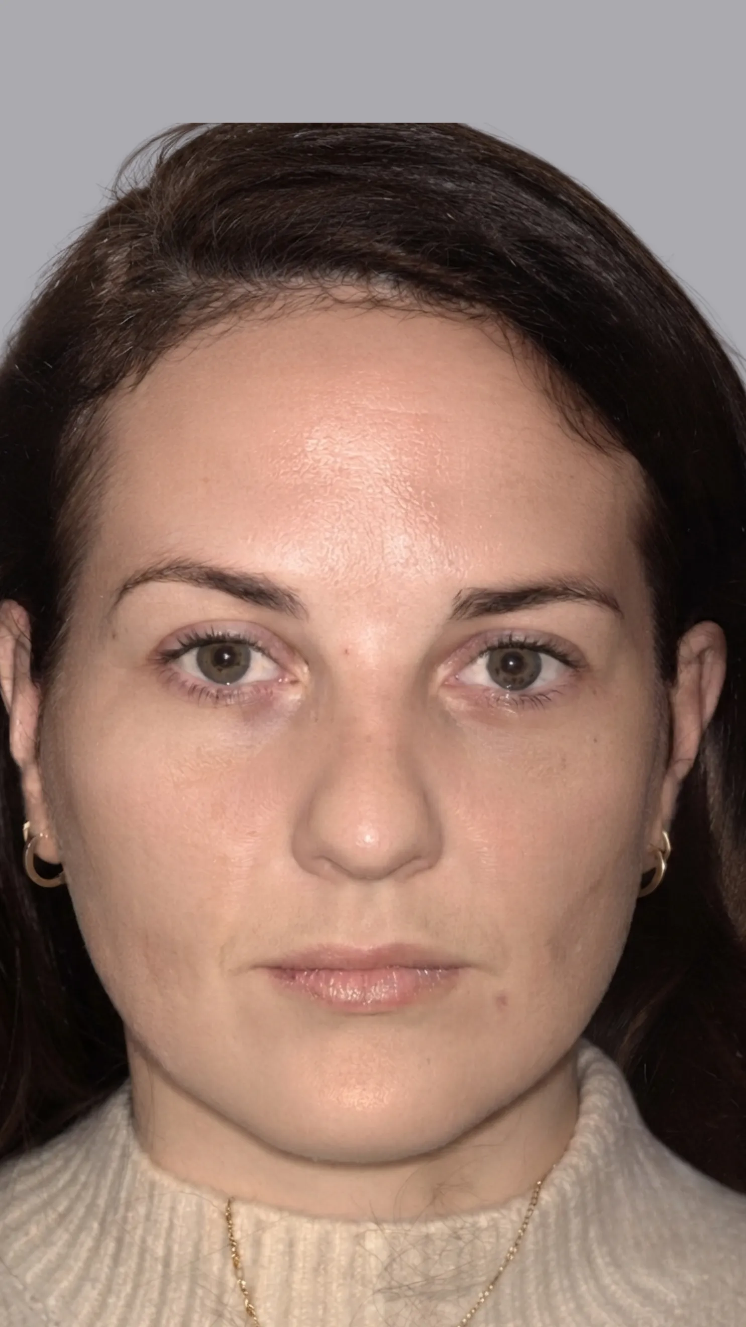 After tear trough filler at Dental & Wellness London, Islington