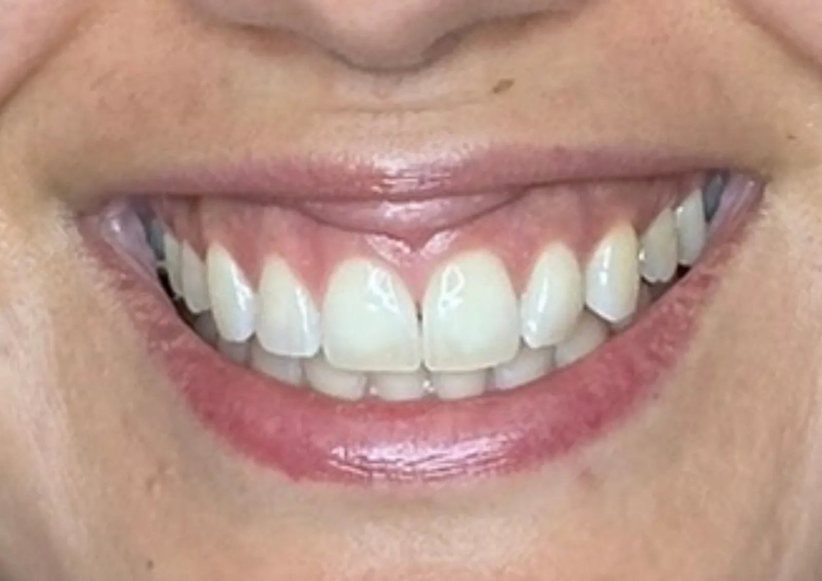 After gummy smile treatment at Dental & Wellness London, Islington