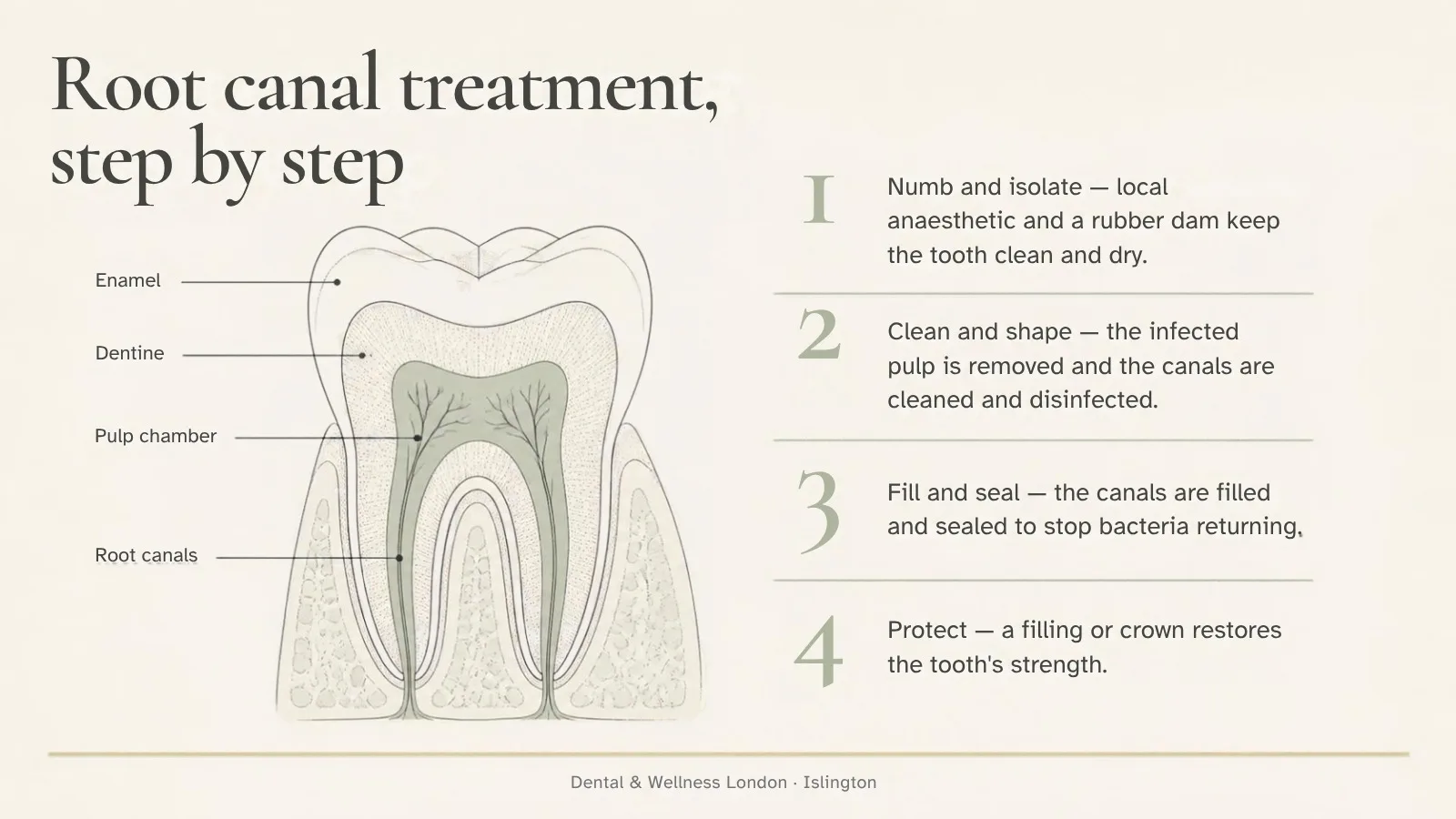 Root canal treatment step by step: diagram of a molar showing enamel, dentine, pulp chamber and root canals, with the four stages of treatment at Dental & Wellness London in Islington