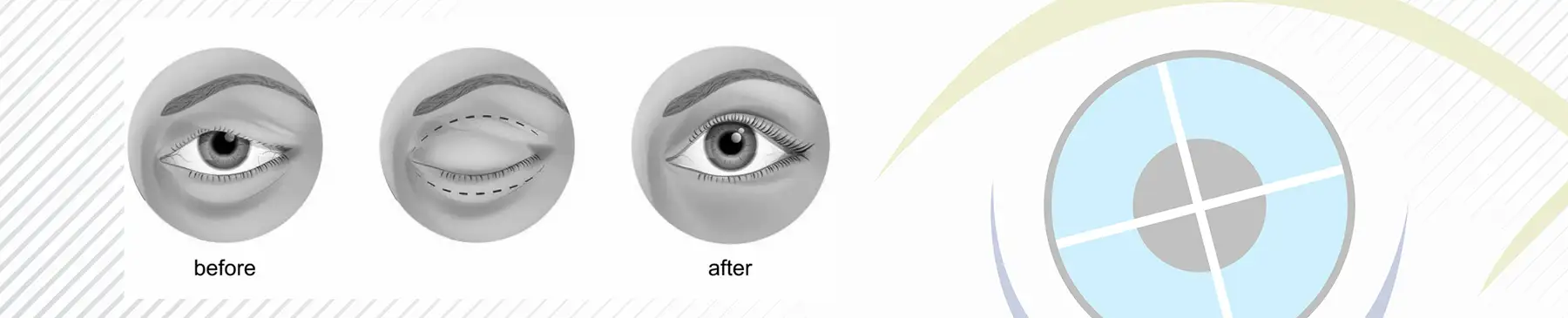 Eyelid Surgeries