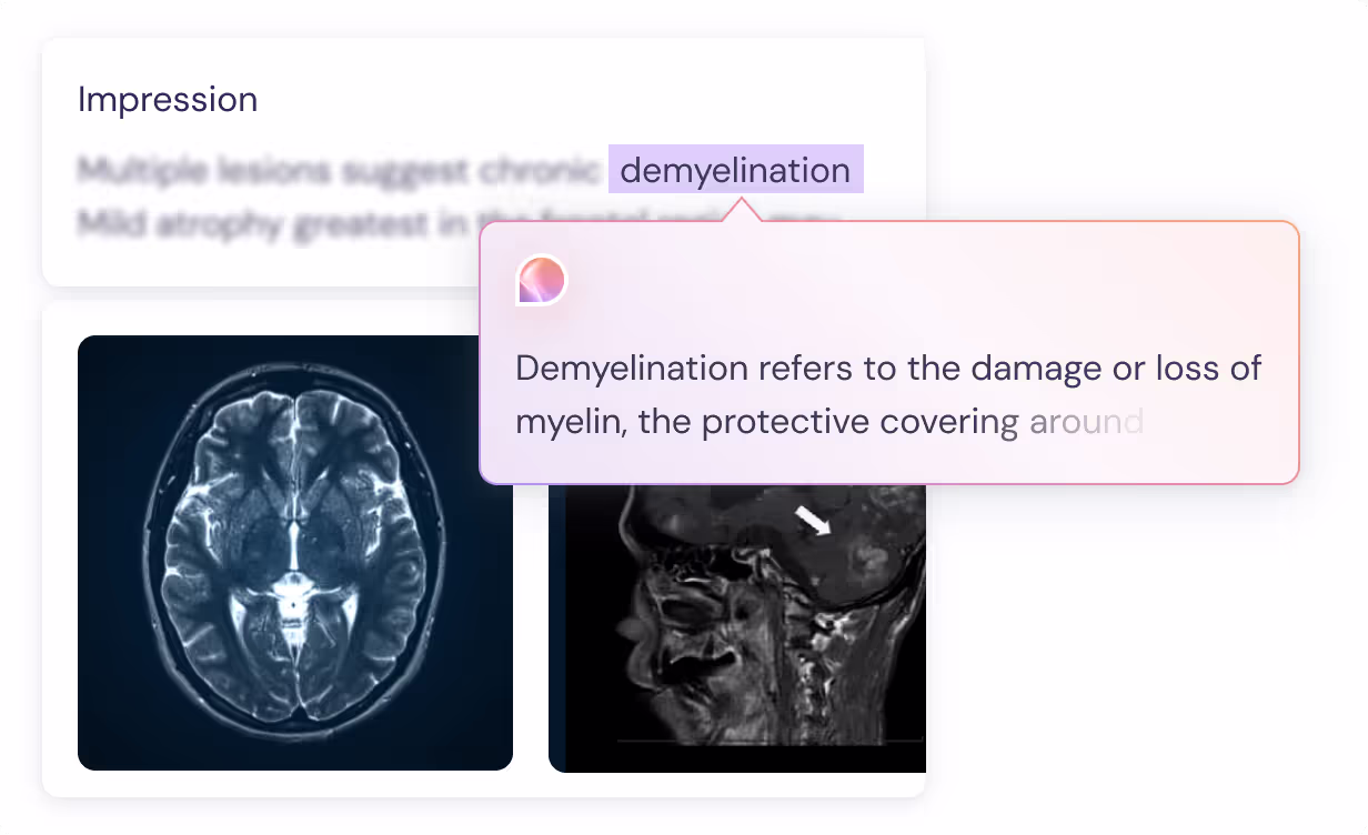 Medical screen showing brain MRI scans with highlighted term 'demyelination' and a tooltip explaining it as damage or loss of myelin.