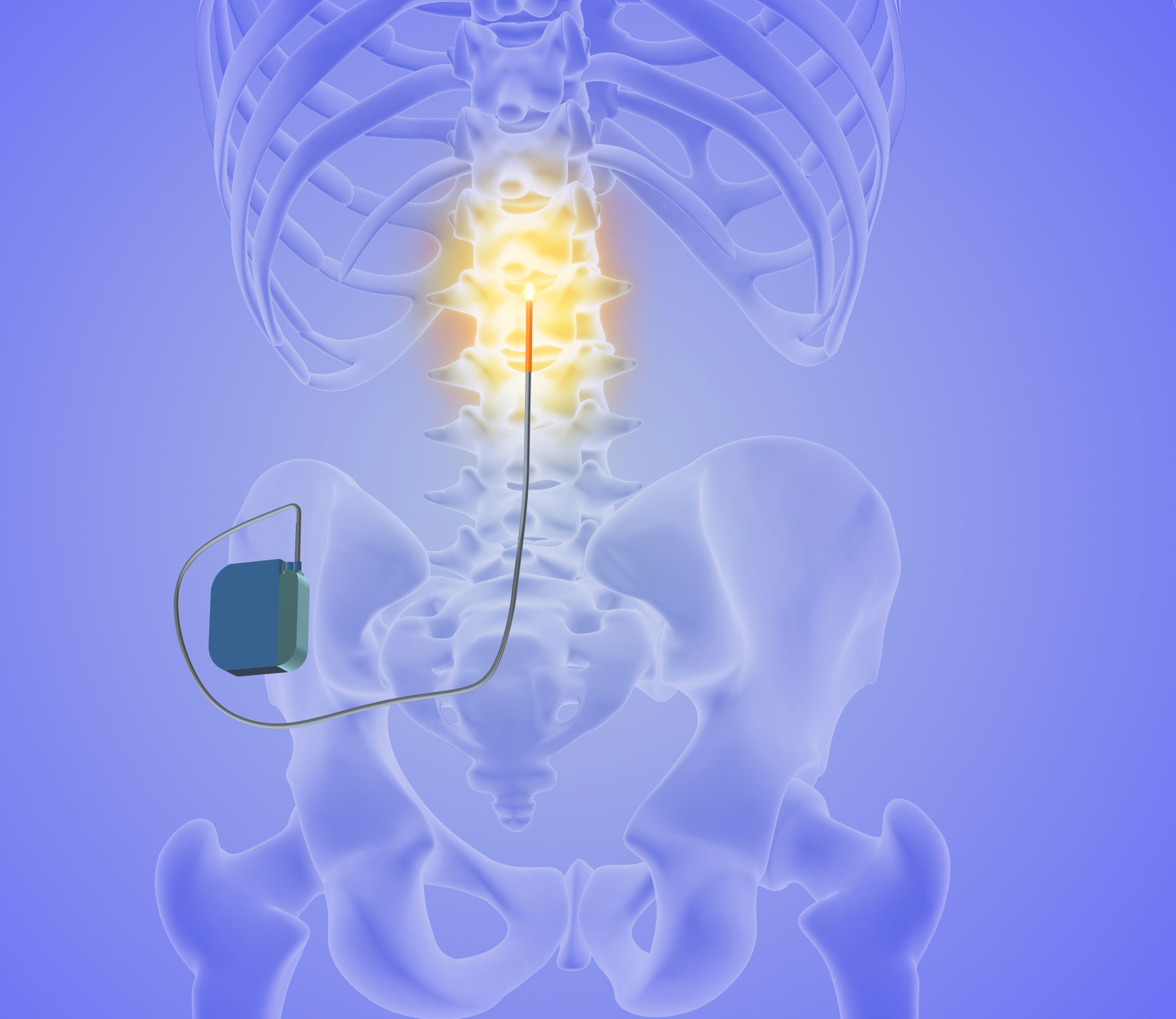 Spinal Cord Stimulator