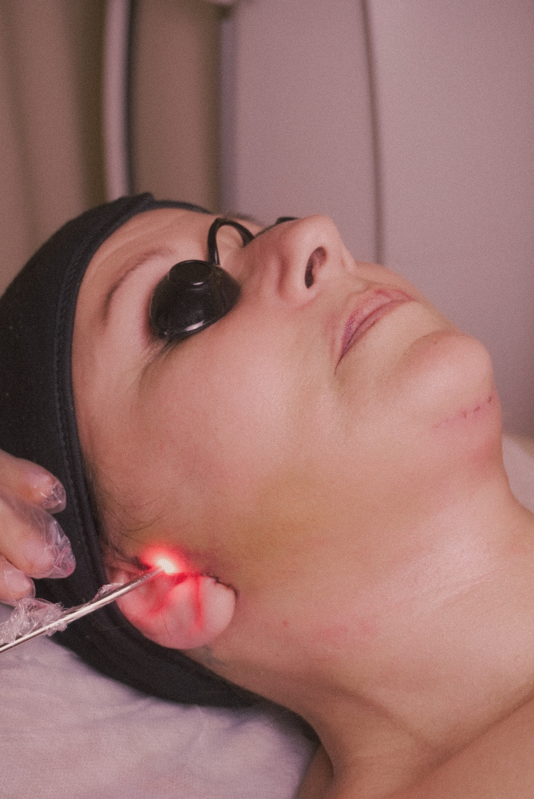 Woman receiving a laser treatment on her jawline while wearing protective black eye covers and a headband.