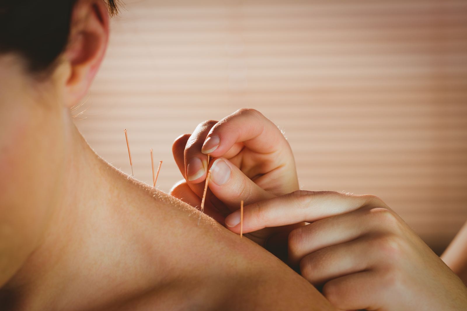 Acupuncture treatment at Omnia Lifestyle in Chiswick